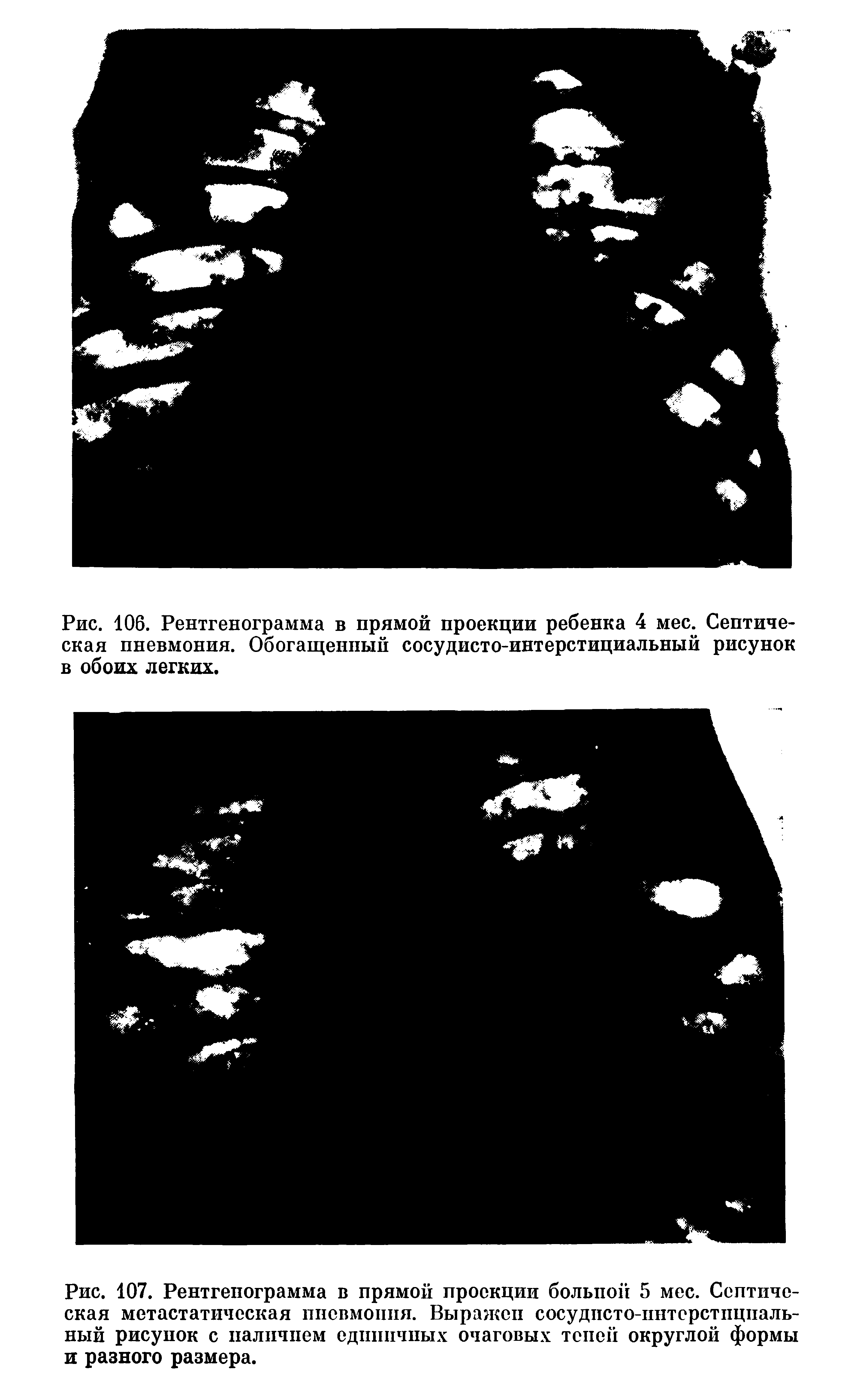Рис. 107. Рентгенограмма в прямой проекции больной 5 мес. Септическая метастатическая пневмония. Выражен сосудпсто-пнтерстпцпаль-ный рисупок с наличием единичных очаговых топей округлой формы и разного размера.