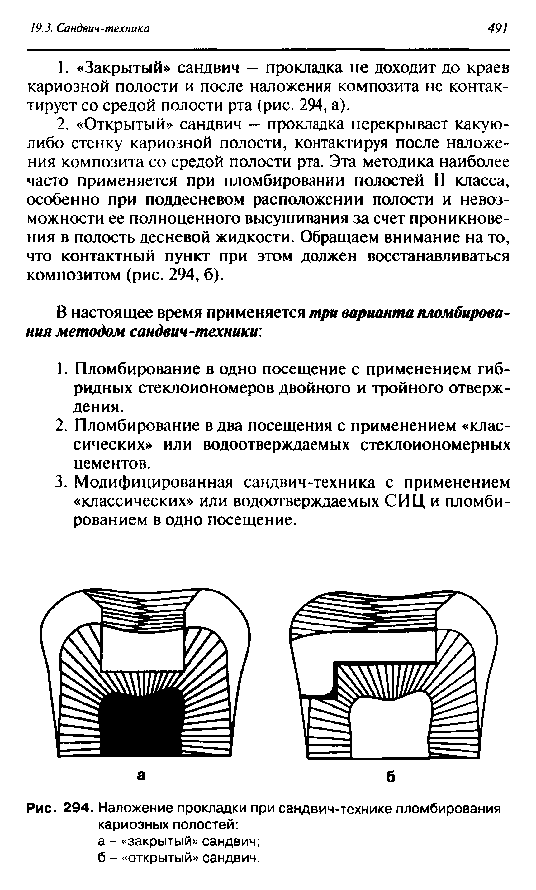 Рис. 294. Наложение прокладки при сандвич-технике пломбирования кариозных полостей ...