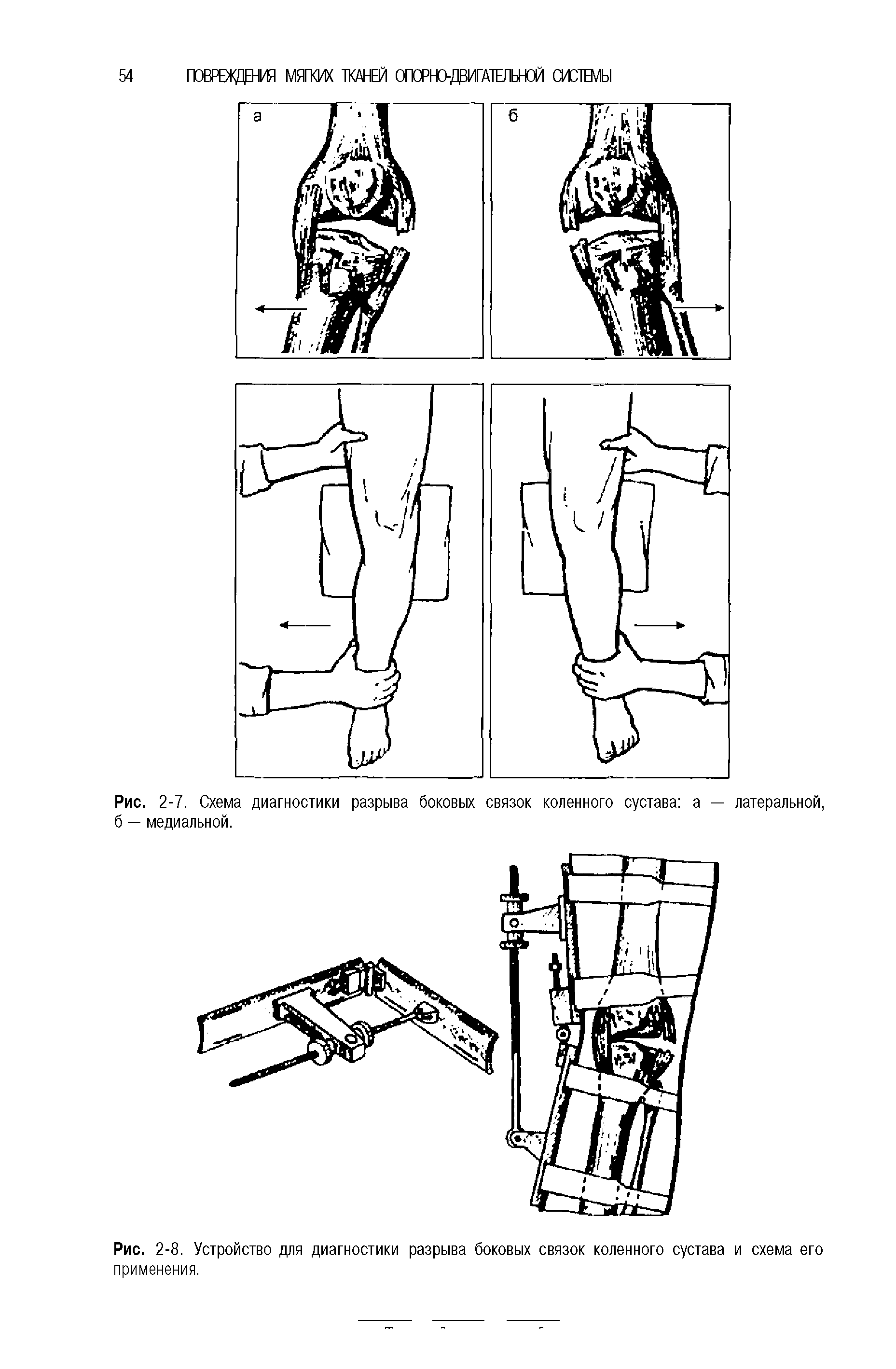 Рис. 2-7. Схема диагностики разрыва боковых связок коленного сустава а — латеральной, б — медиальной.