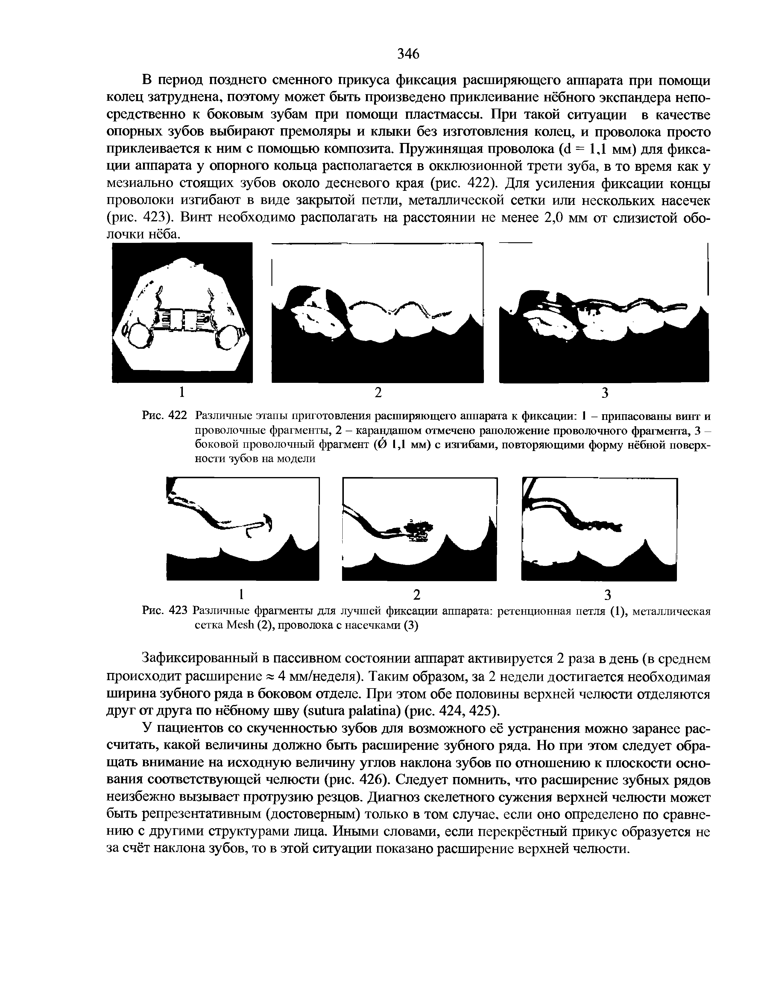 Рис. 423 Различные фрагменты для лучшей фиксации аппарата ретенционная петля (1), металлическая сетка M (2), проволока с насечками (3)...