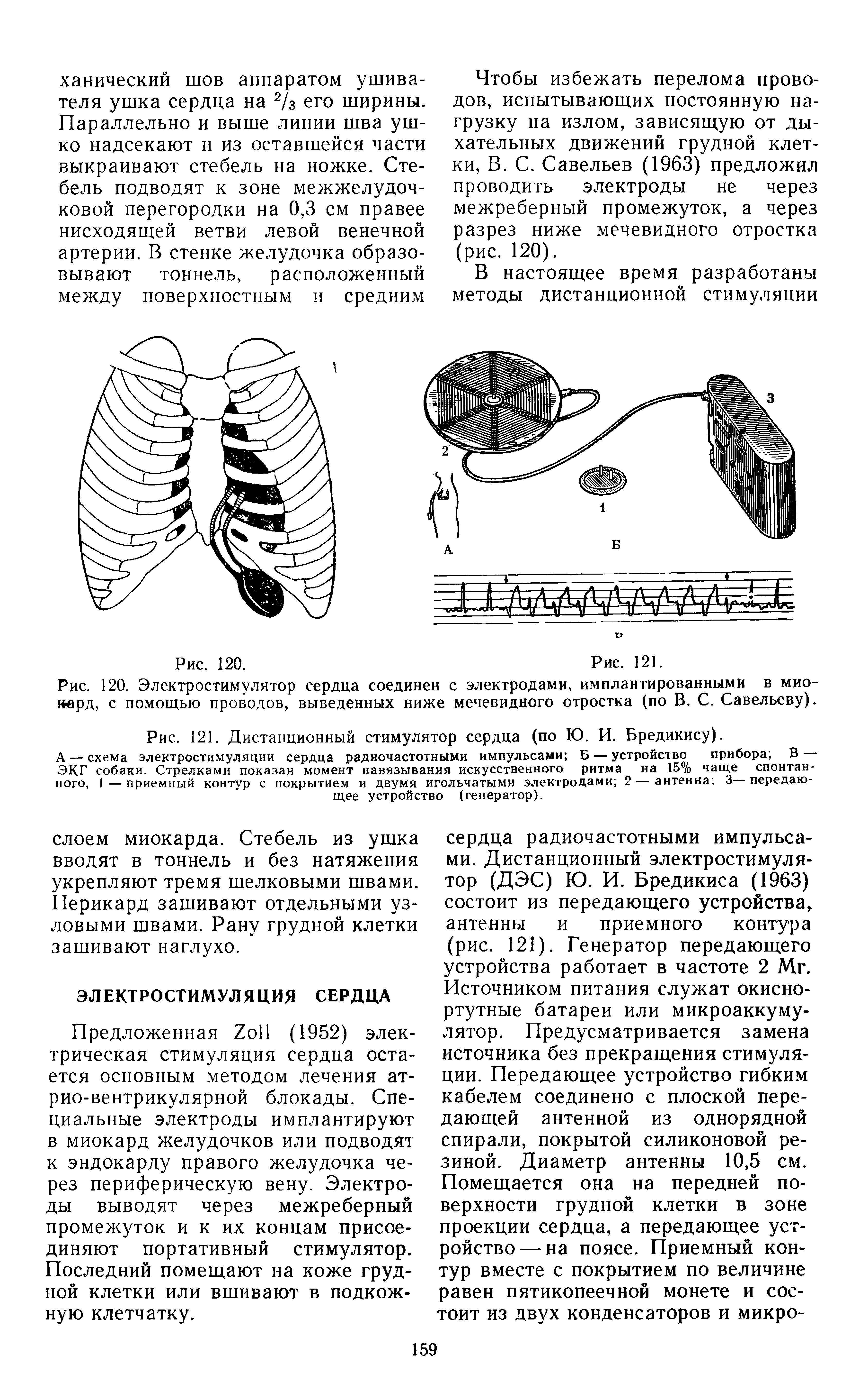 Рис. 120. Электростимулятор сердца соединен с электродами, имплантированными в мио-кврд, с помощью проводов, выведенных ниже мечевидного отростка (по В. С. Савельеву).