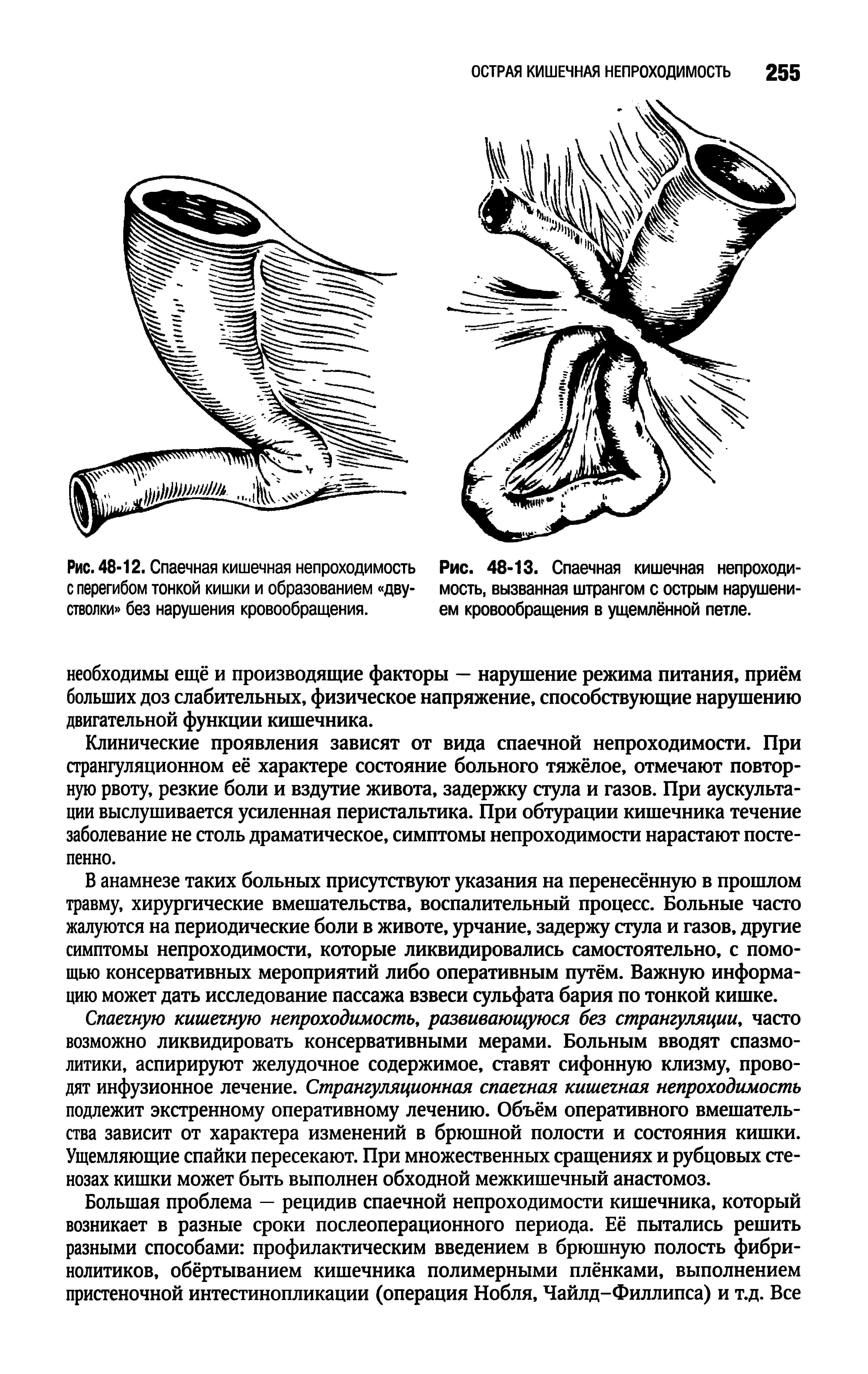 Рис. 48-13. Спаечная кишечная непроходимость, вызванная штрангом с острым нарушением кровообращения в ущемлённой петле.