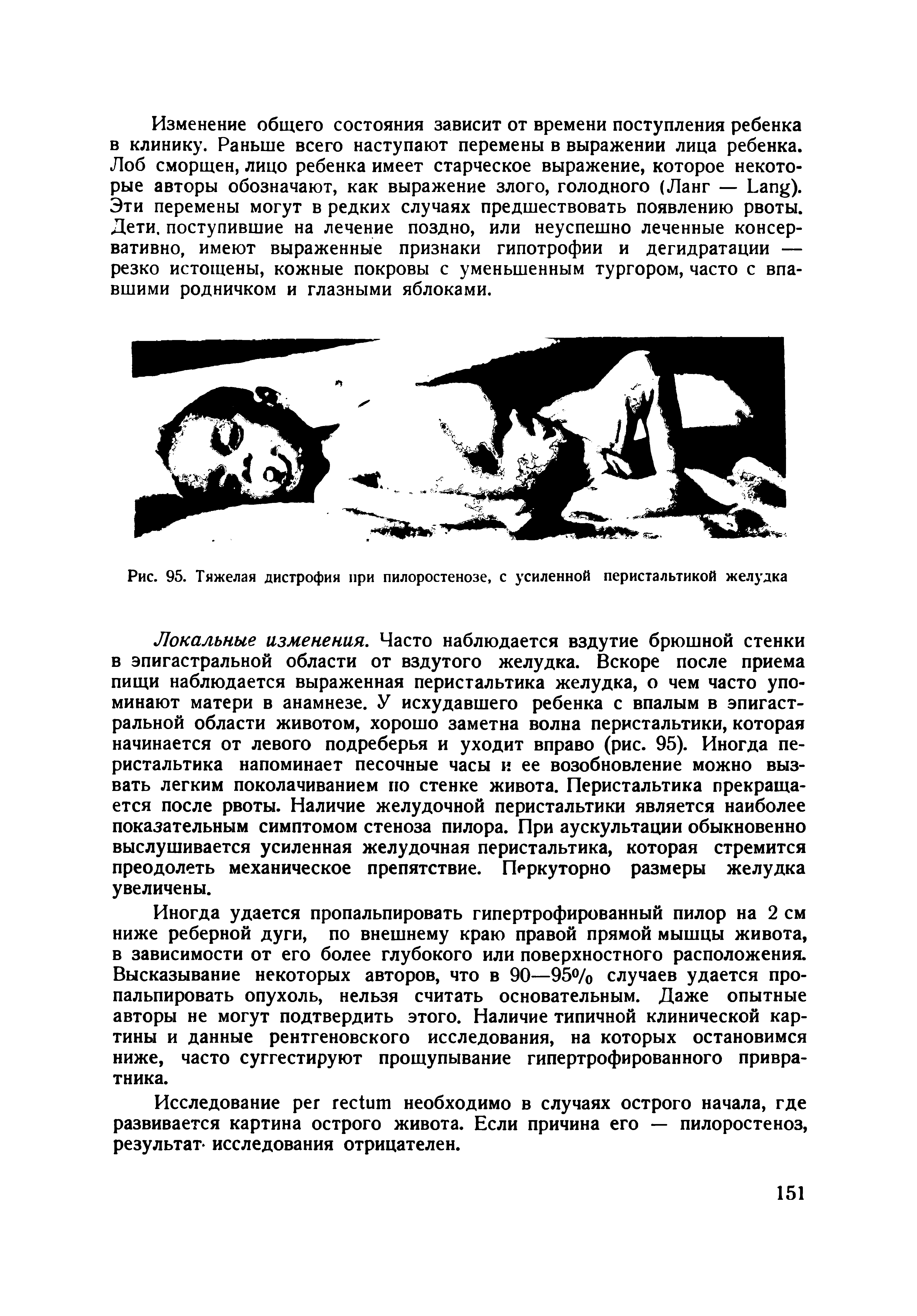 Рис. 95. Тяжелая дистрофия при пилоростенозе, с усиленной перистальтикой желудка...