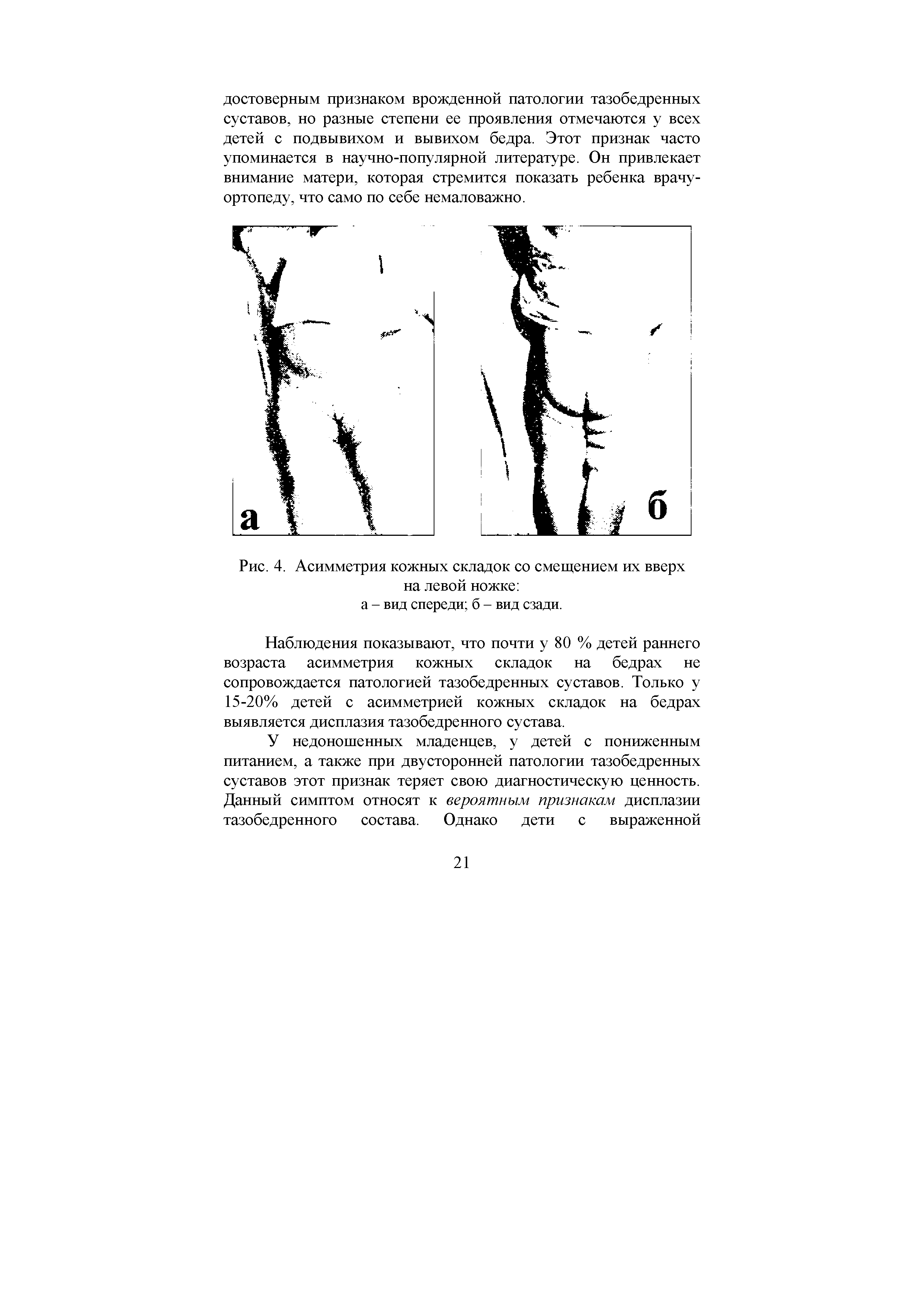 Рис. 4. Асимметрия кожных складок со смещением их вверх на левой ножке ...