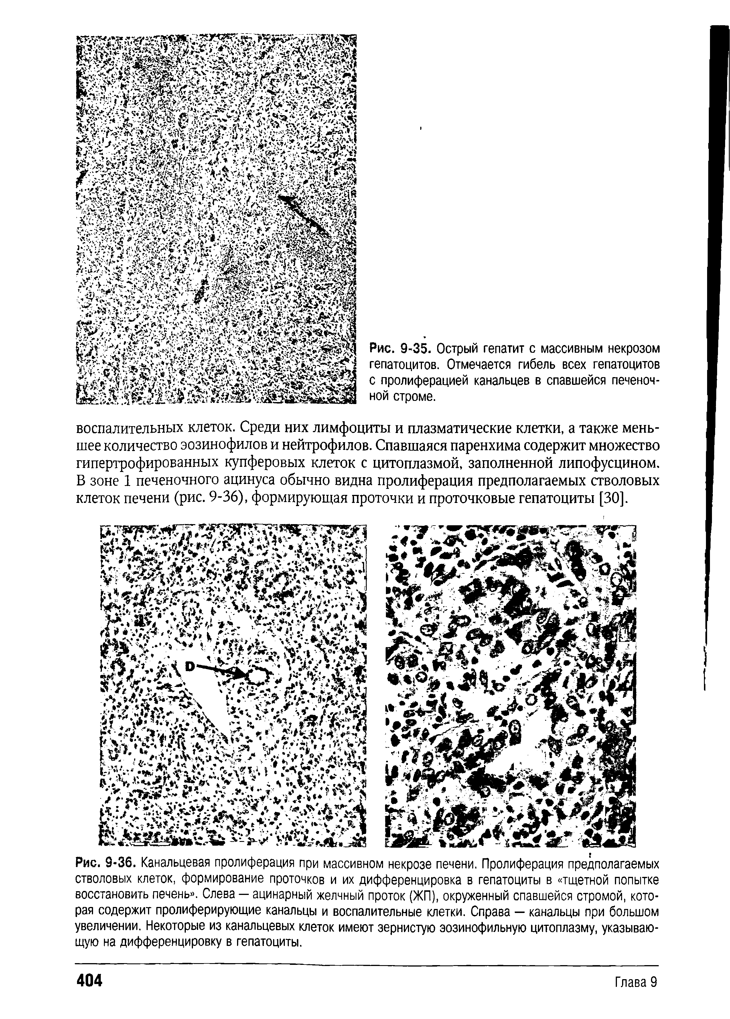 Рис. 9-36. Канальцевая пролиферация стволовых клеток, формирование восстановить печень . Слева — рая содержит пролиферирующие канальцы...