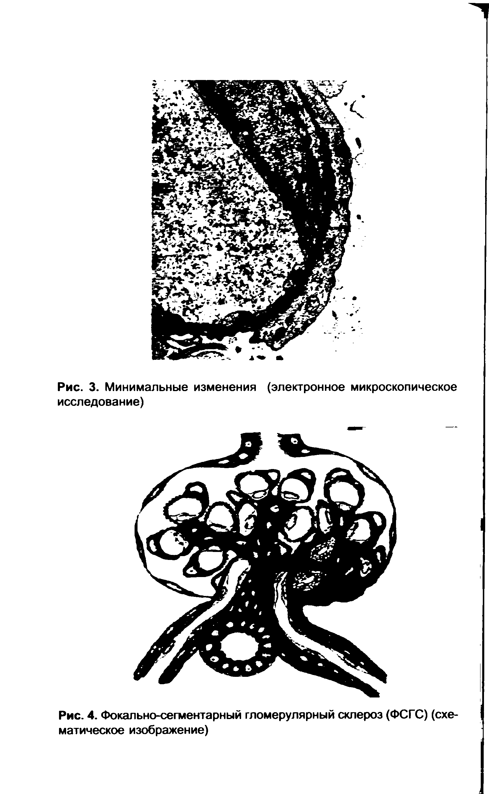 Рис. 4. Фокально-сегментарный гломерулярный склероз (ФСГС) (схематическое изображение)...