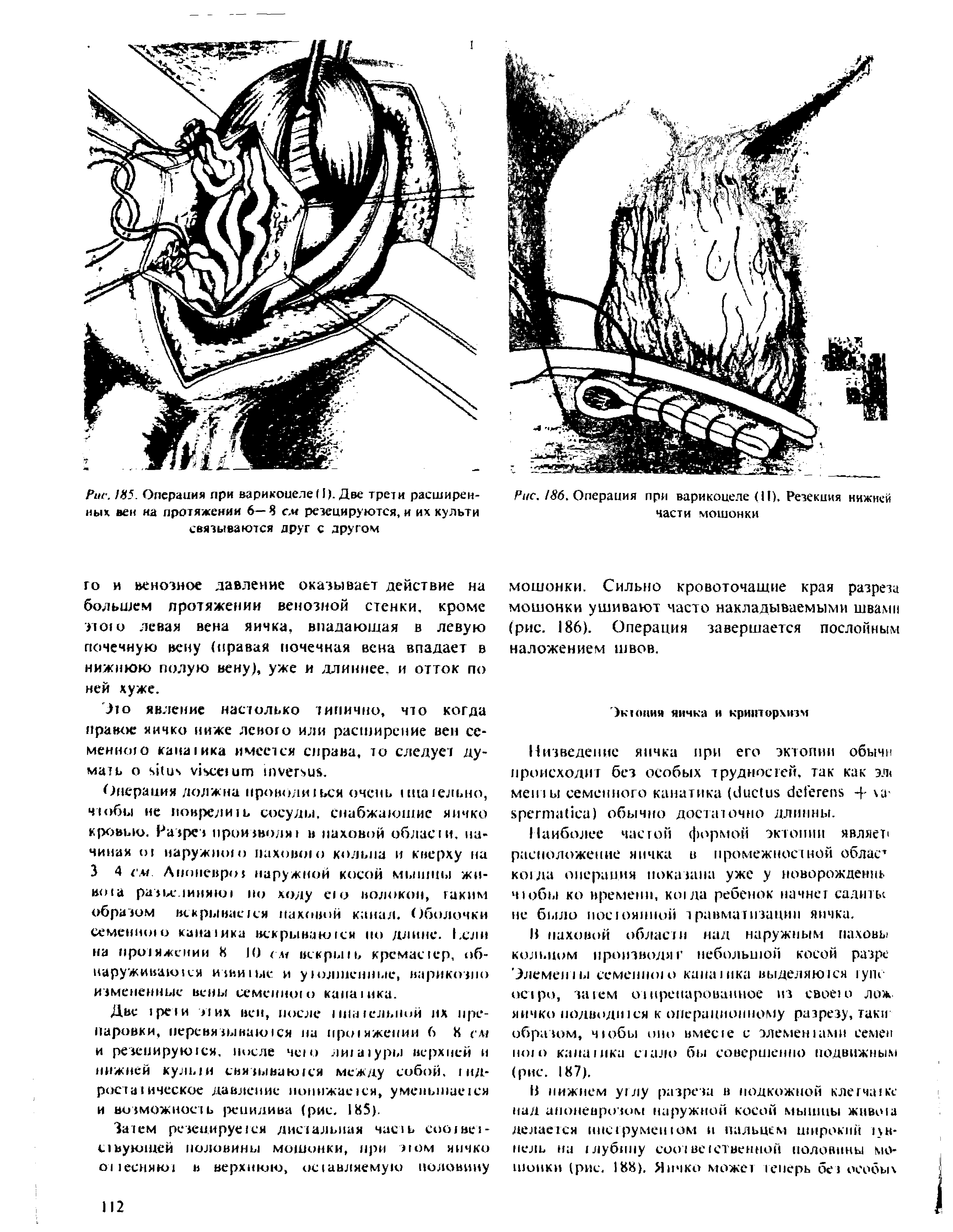 Рис. 186, Операция при варикоцеле (II), Резекция нижней части мошонки...