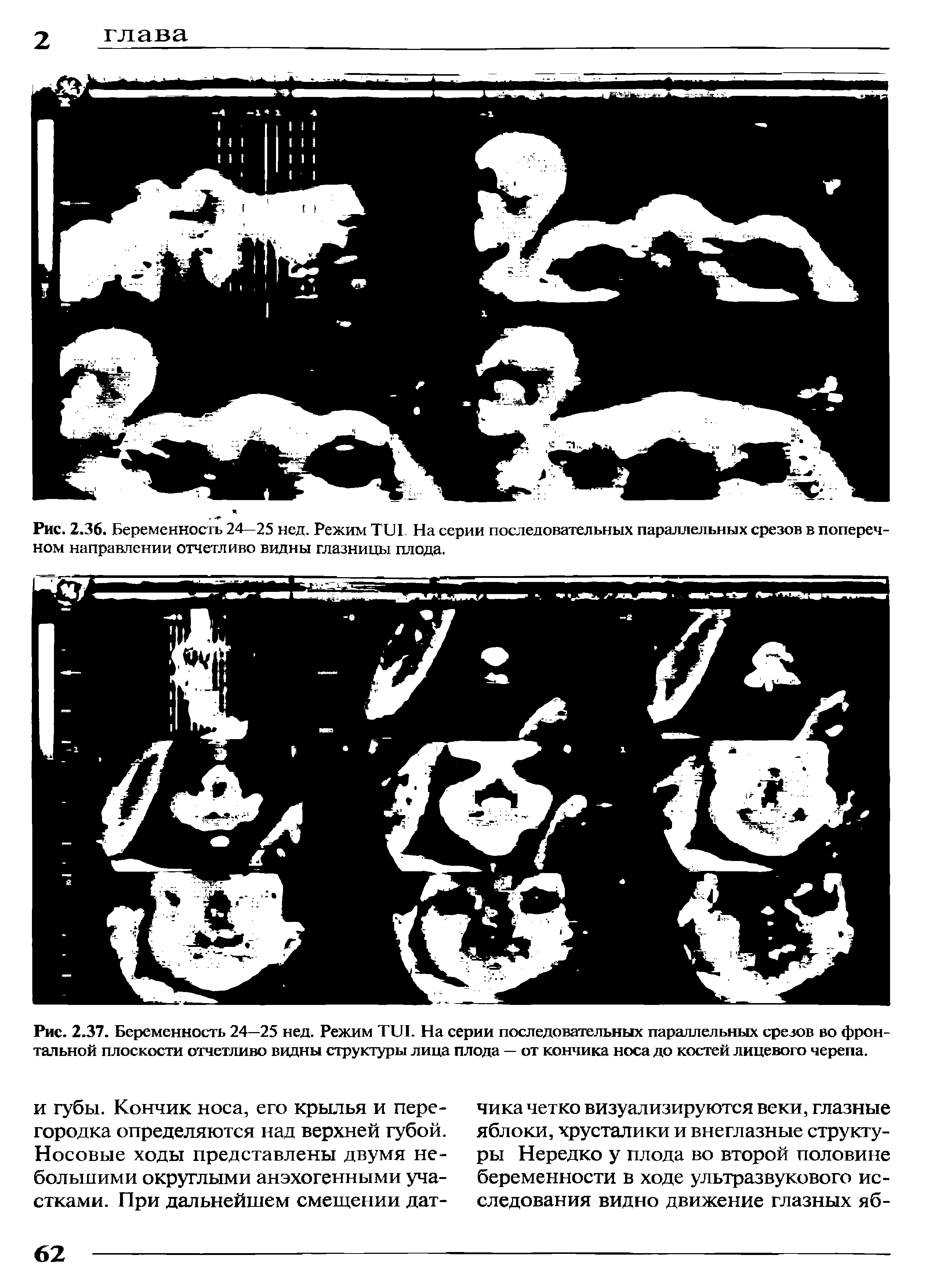 Рис. 2.37. Беременность 24—25 нед. Режим TUI. На серии последовательных параллельных срезов во фронтальной плоскости отчетливо видны структуры лица плода — от кончика носа до костей лицевого черепа.