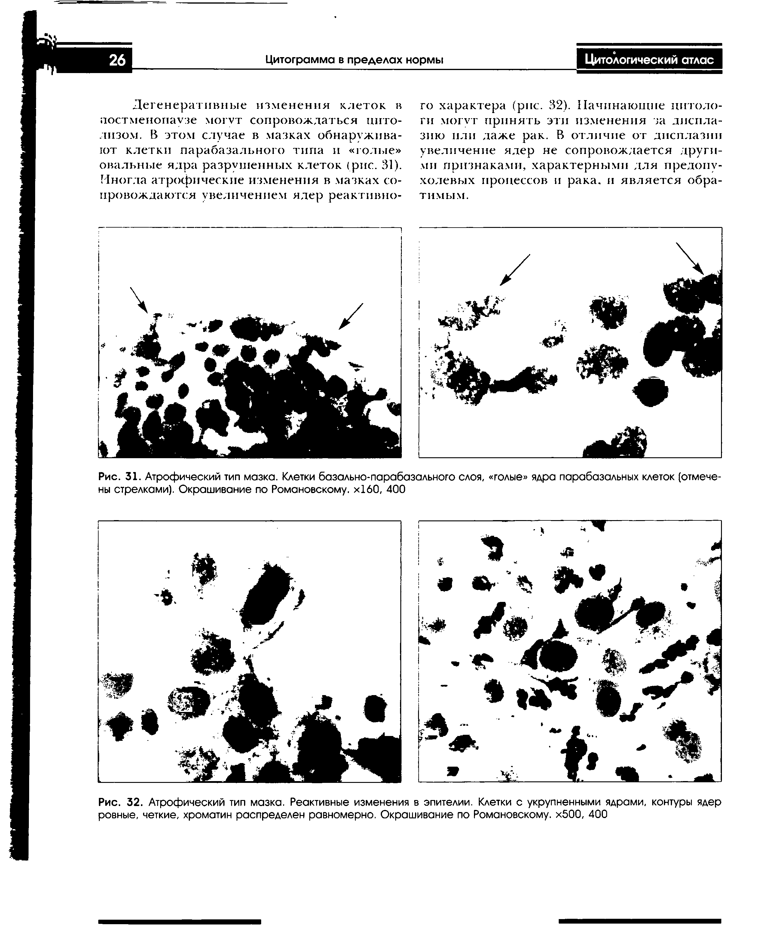 Рис. 31. Атрофический тип мазка. Клетки базально-парабазального слоя, голые ядра парабазальных клеток (отмечены стрелками). Окрашивание по Романовскому. х 60, 400...