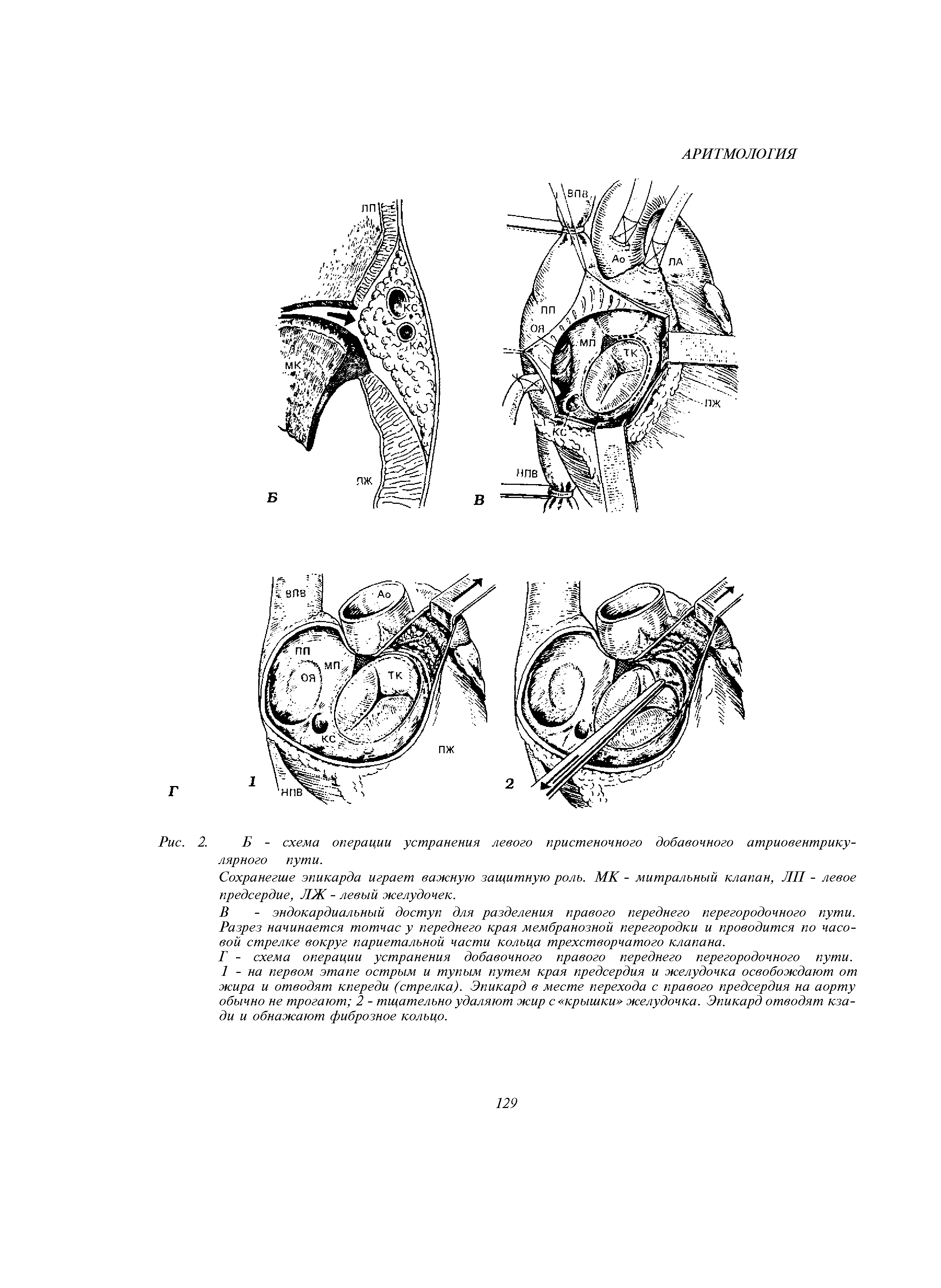 Рис. 2. Б - схема операции устранения левого пристеночного добавочного атриовентрикулярного пути.