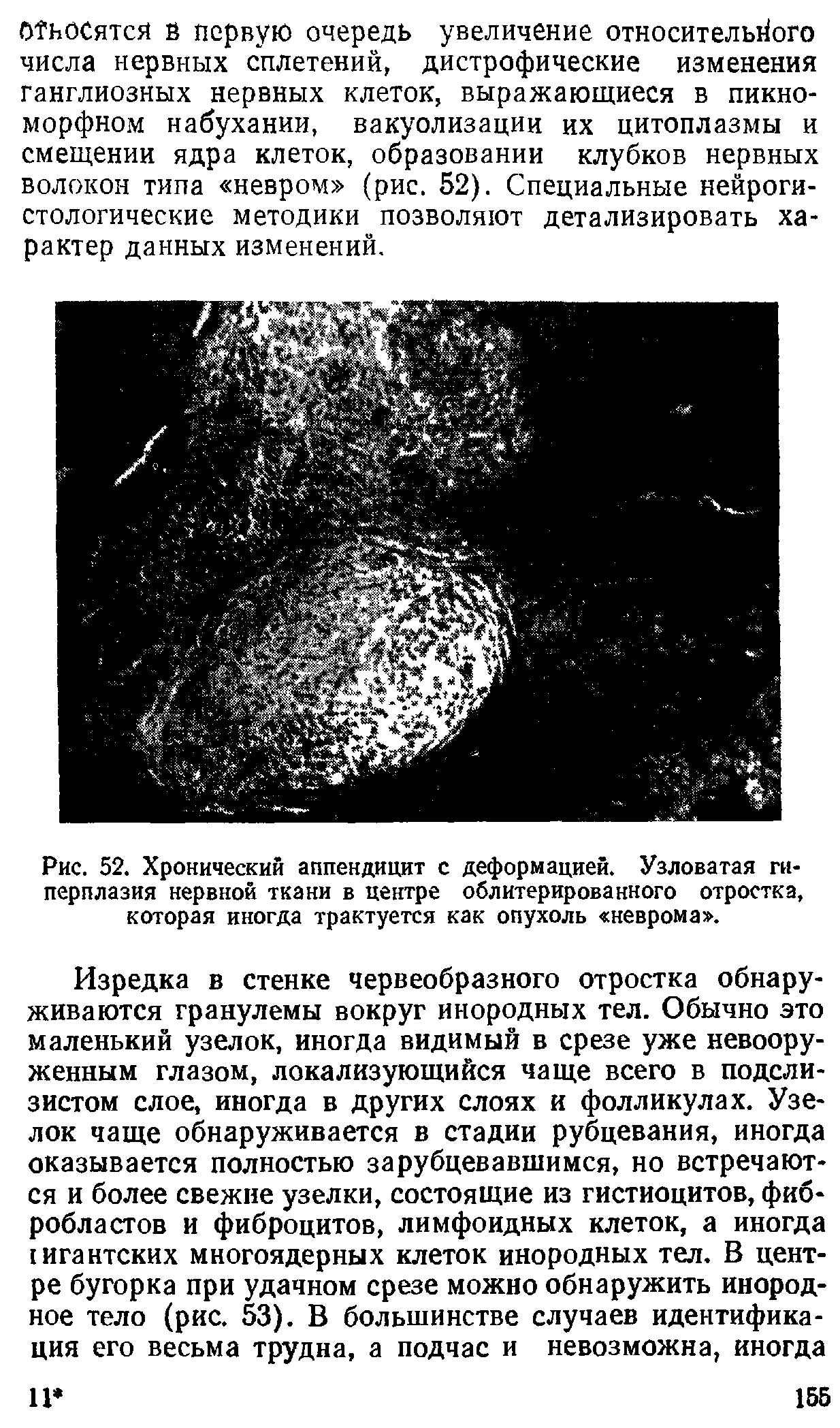 Рис. 52. Хронический аппендицит с деформацией. Узловатая гиперплазия нервной ткани в центре облитерированного отростка, которая иногда трактуется как опухоль неврома .