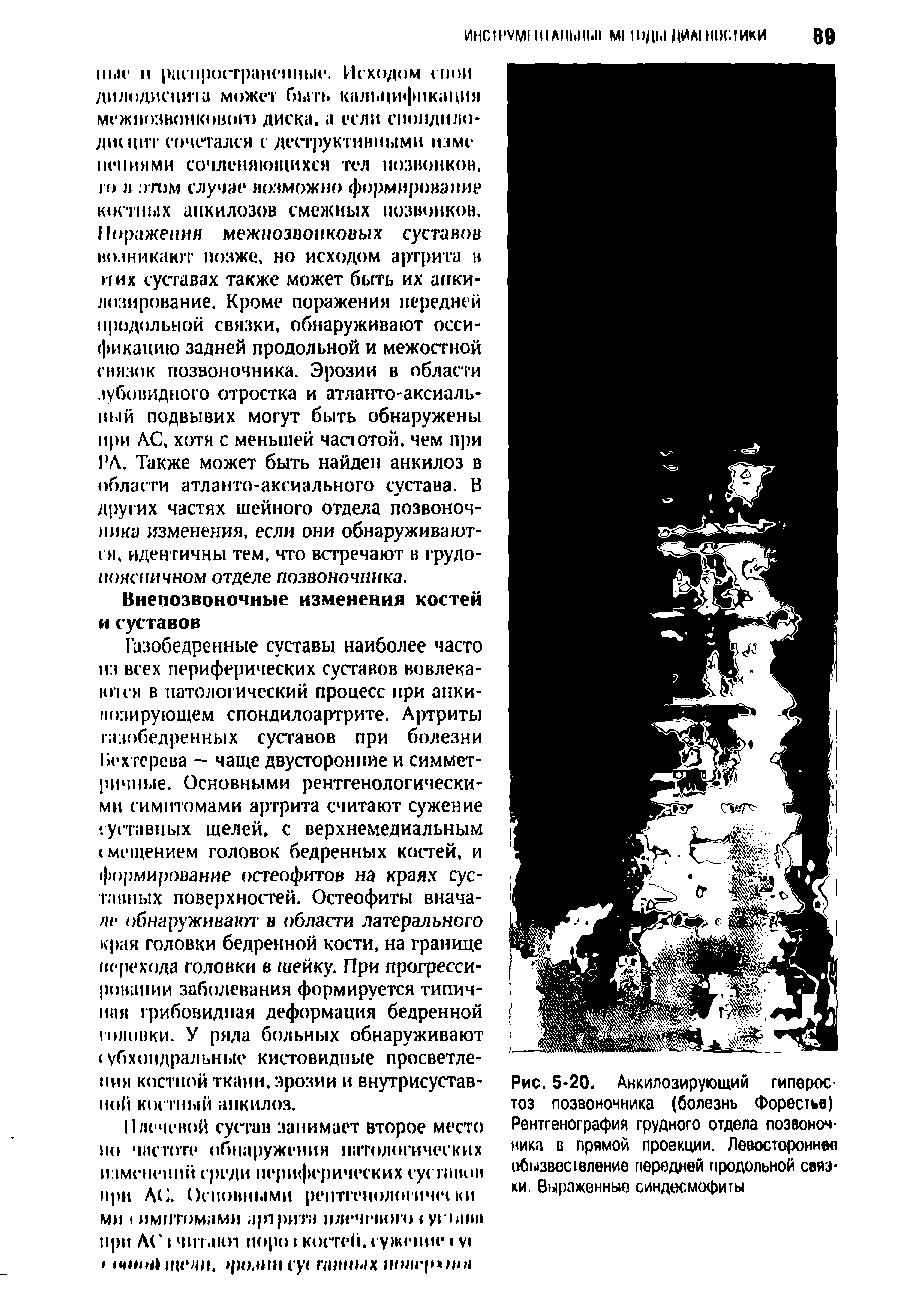 Рис. 5-20. Анкилозирующий гиперостоз позвоночника (болезнь Форестье) Рентгенография грудного отдела позвоночника в прямой проекции. Левостороннее обызвес1вление передней продольной связки. Выраженные синдесмофигы...