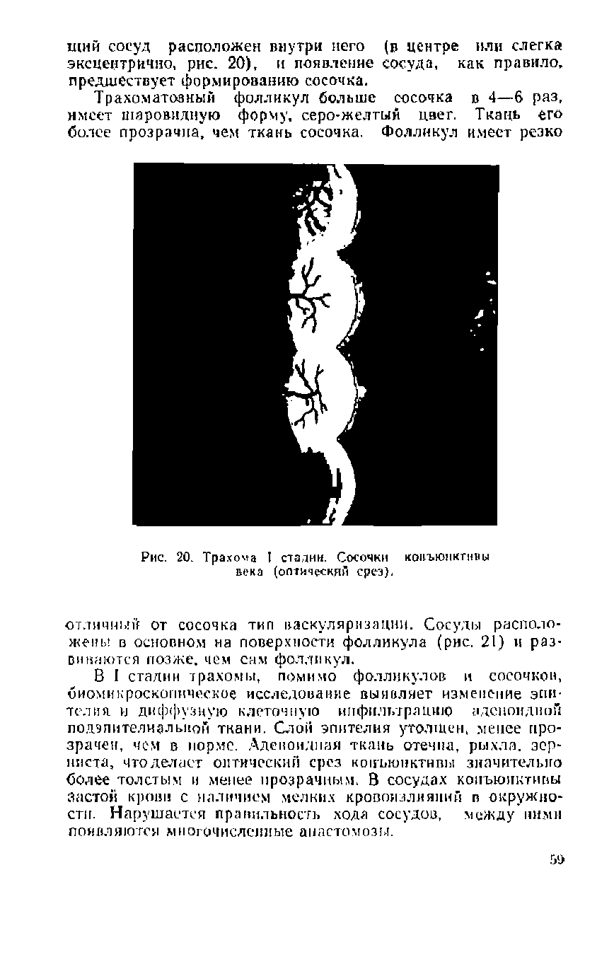 Рис. 20. Трахома I статин. Сосочки конъюнктивы века (оптический срез).