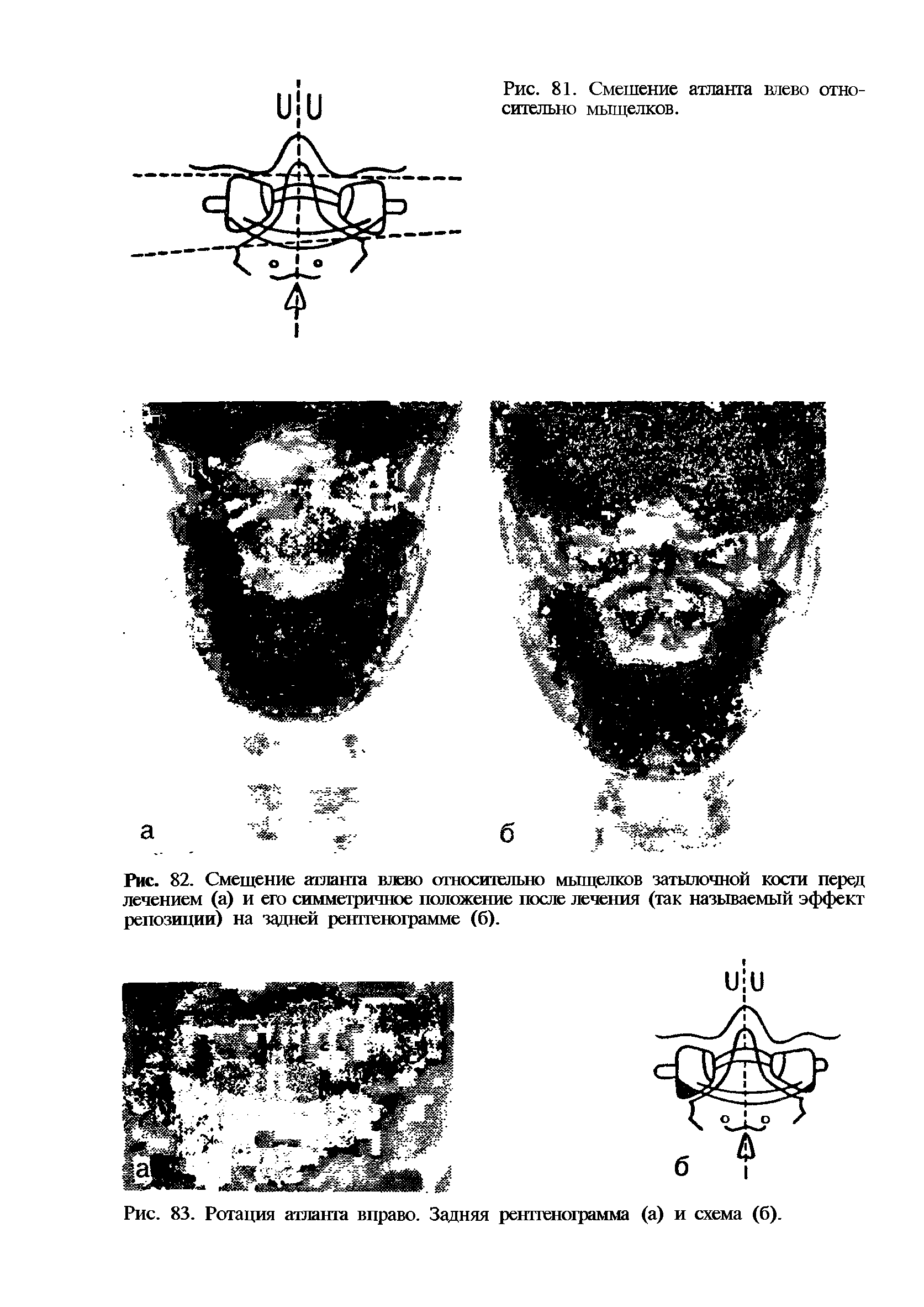 Рис. 82. Смещение атланта влево относительно мыщелков затылочной кости перед лечением (а) и его симметричное положение после лечения (так называемый эффект репозиции) на задней рентгенограмме (б).