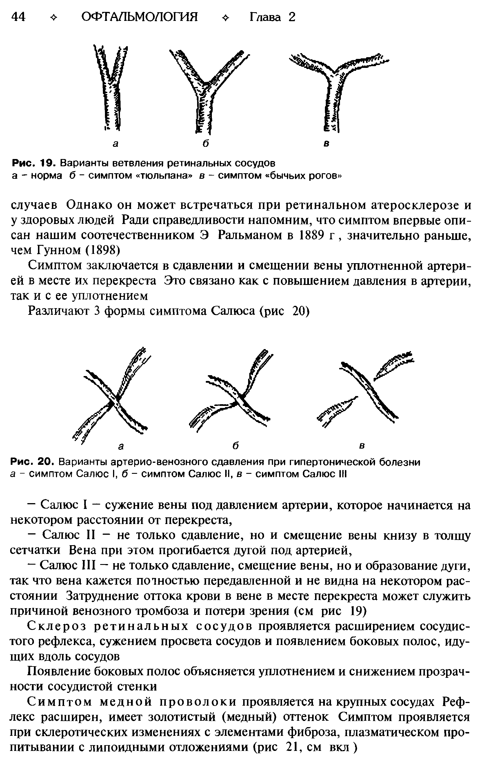 Рис. 20. Варианты артерио-венозного сдавления при гипертонической болезни а - симптом Салюс 1,6- симптом Салюс II, в - симптом Салюс III...