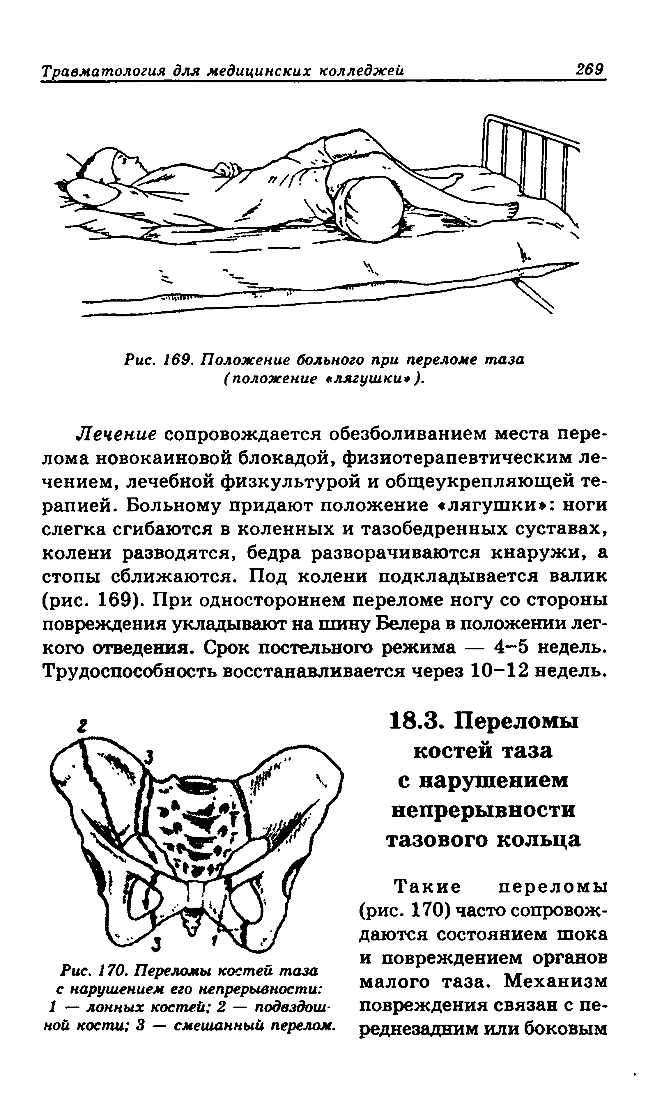 Рис. 169. Положение больного при переломе таза (положение лягушки ).