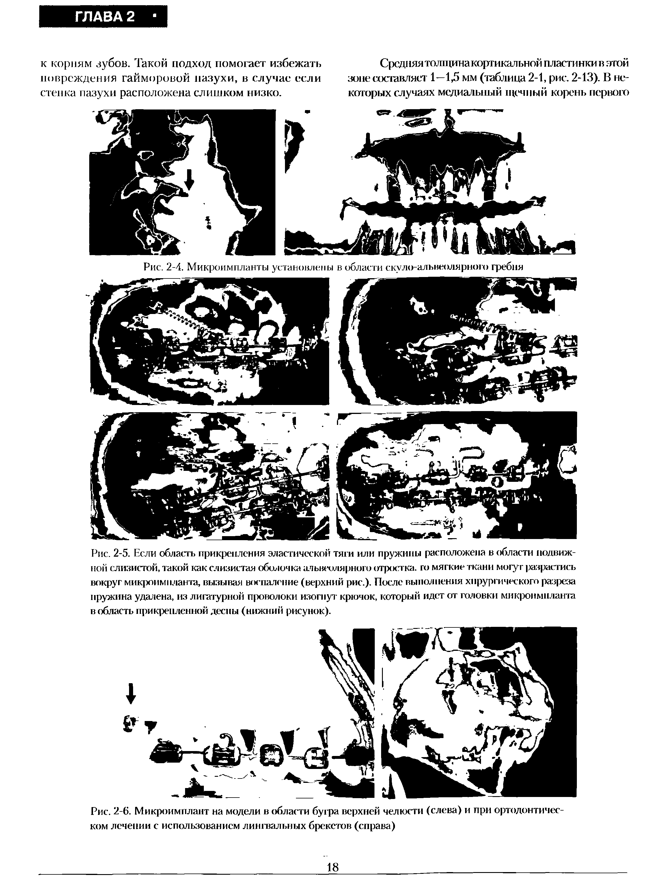 Рис. 2-6. Микроимплант на модели в области бугра верхней челюсти (слева) и при ортодонтическом лечении с использованием лингвальных брекетов (справа)...