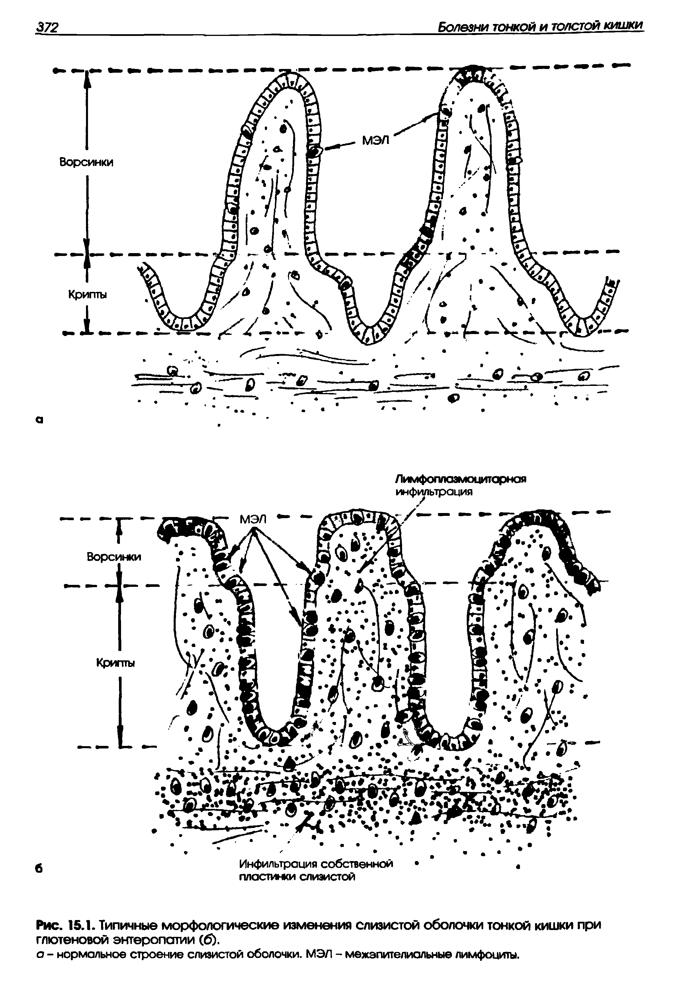Рис. 15.1. Типичные морфологические изменения слизистой оболочки тонкой кишки при глютеновой энтеропатии (б).