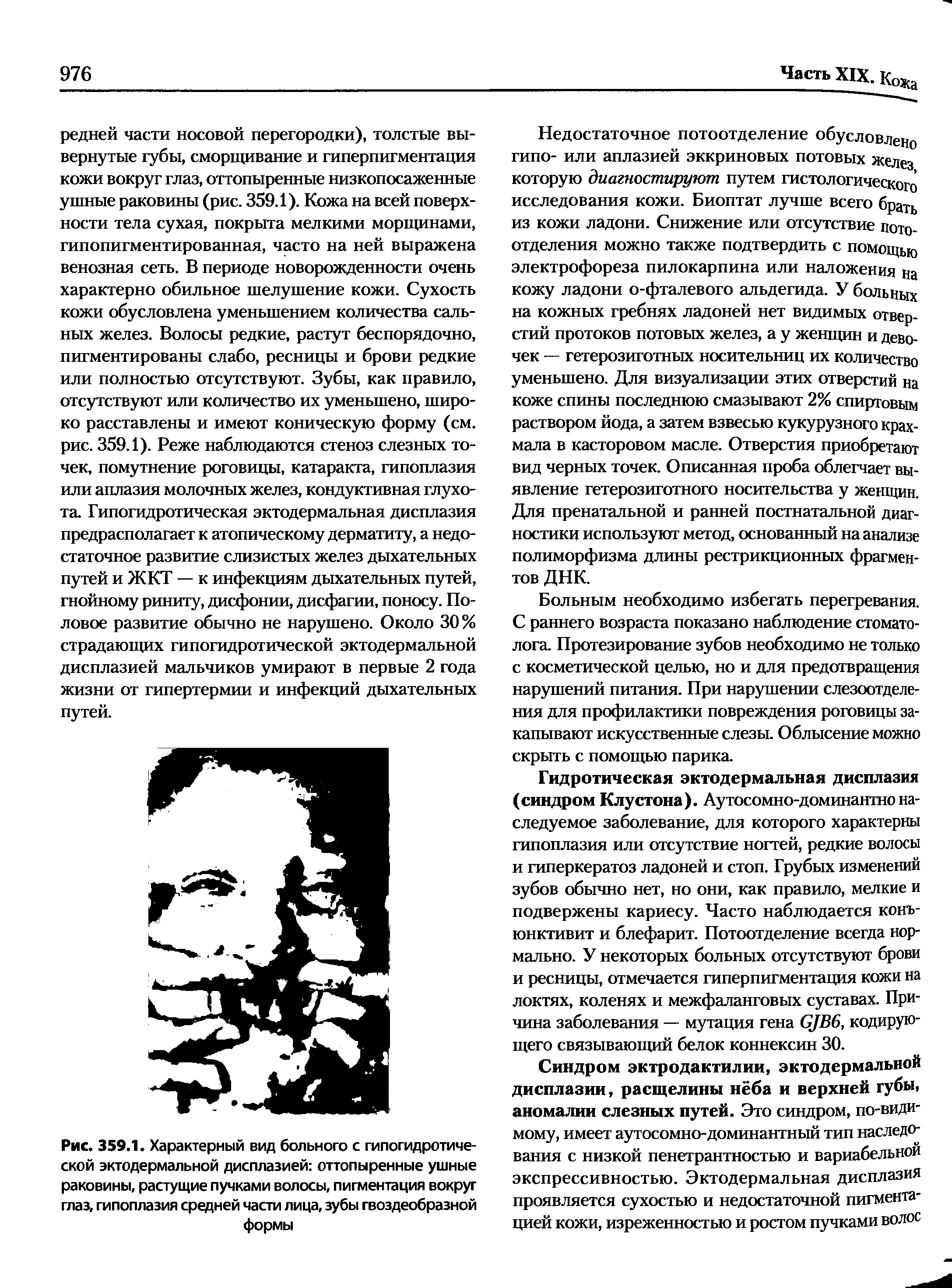 Рис. 359.1. Характерный вид больного с гипогидротической эктодермальной дисплазией оттопыренные ушные раковины, растущие пучками волосы, пигментация вокруг глаз, гипоплазия средней части лица, зубы гвоздеобразной формы...