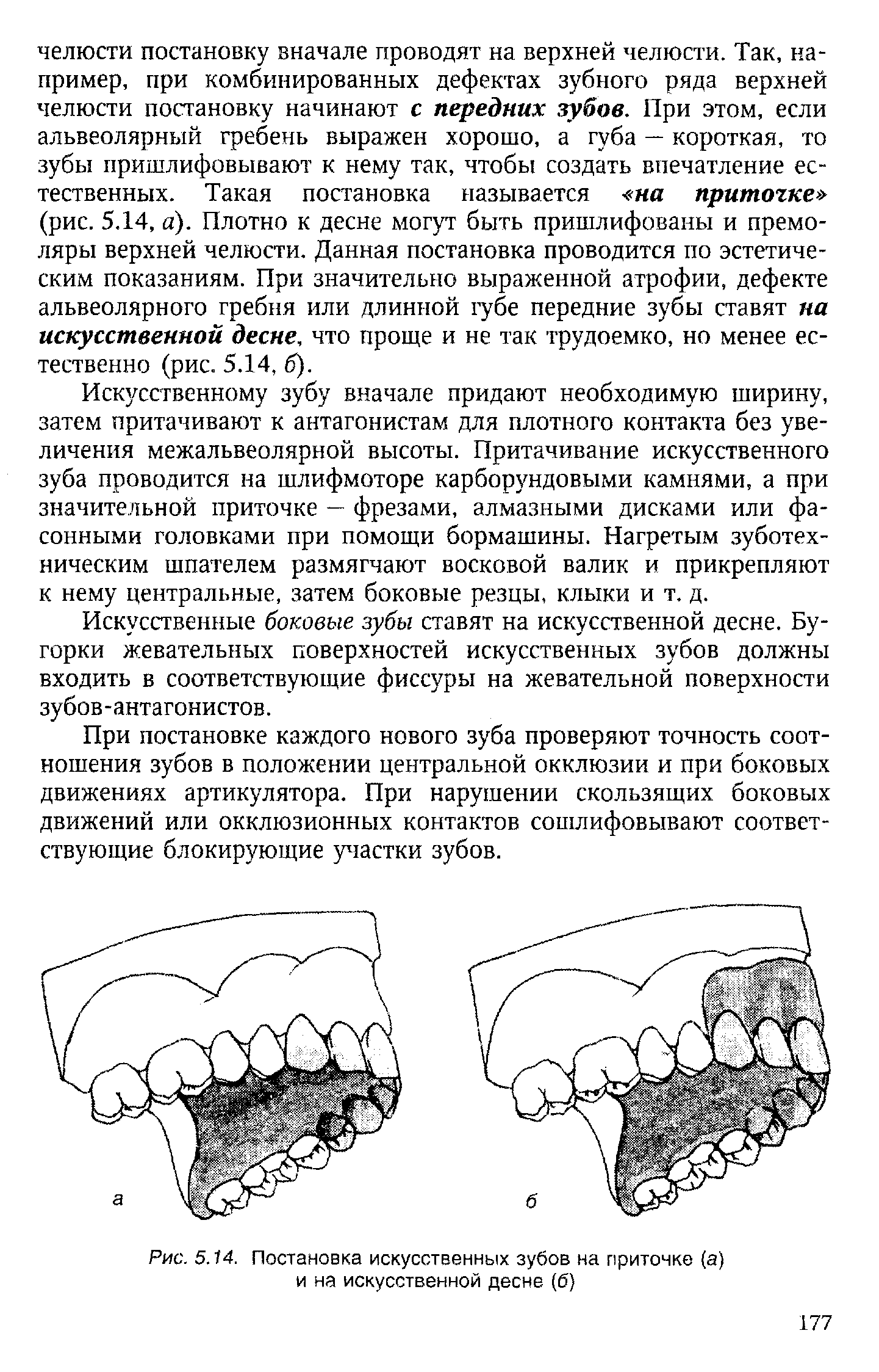 Рис. 5.14. Постановка искусственных зубов на приточке (а) и на искусственной десне (6)...