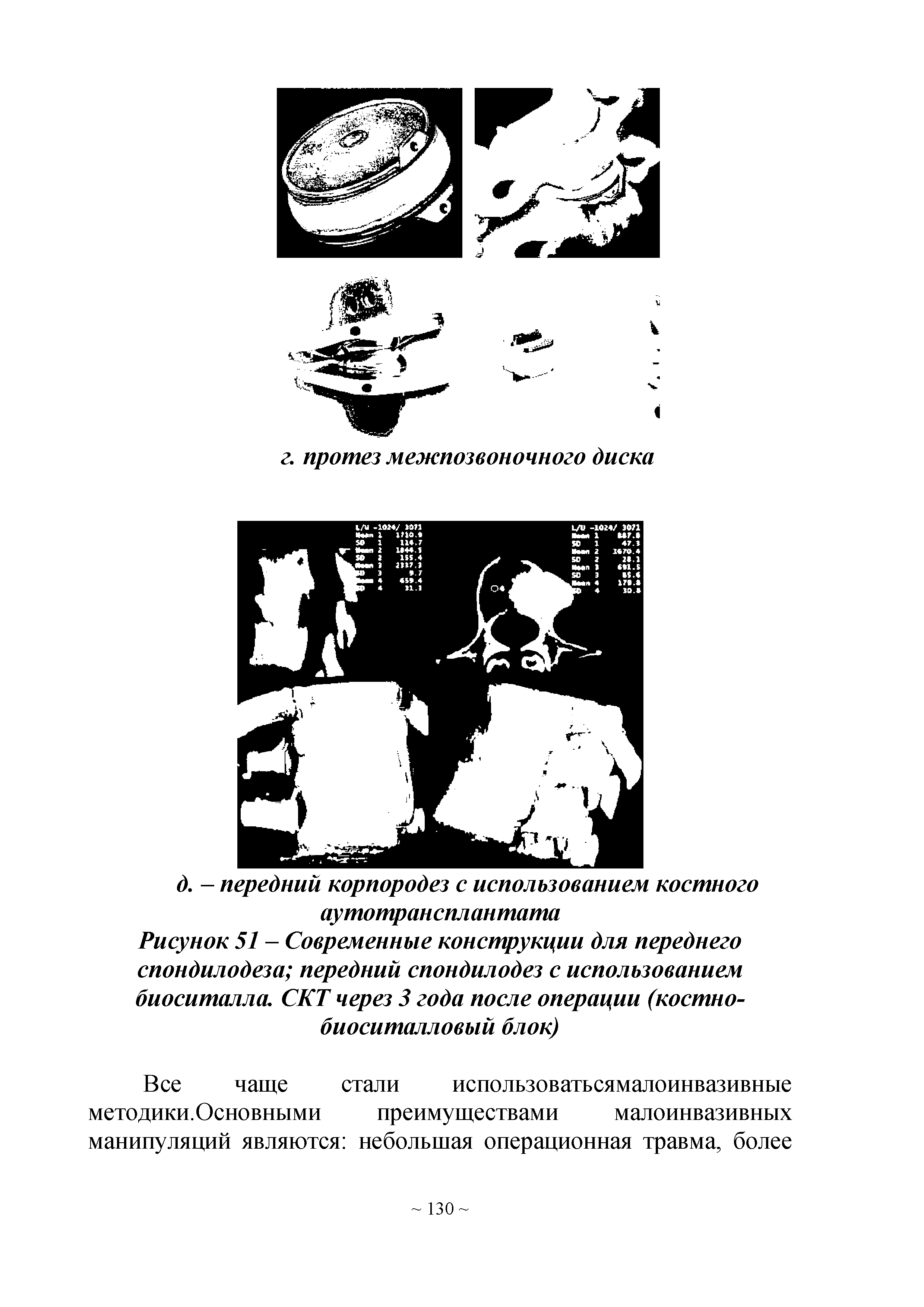 Рисунок 51 - Современные конструкции для переднего спондилодеза передний спондилодез с использованием биоситалла. СКТ через 3 года после операции (костно-биоситалловый блок)...