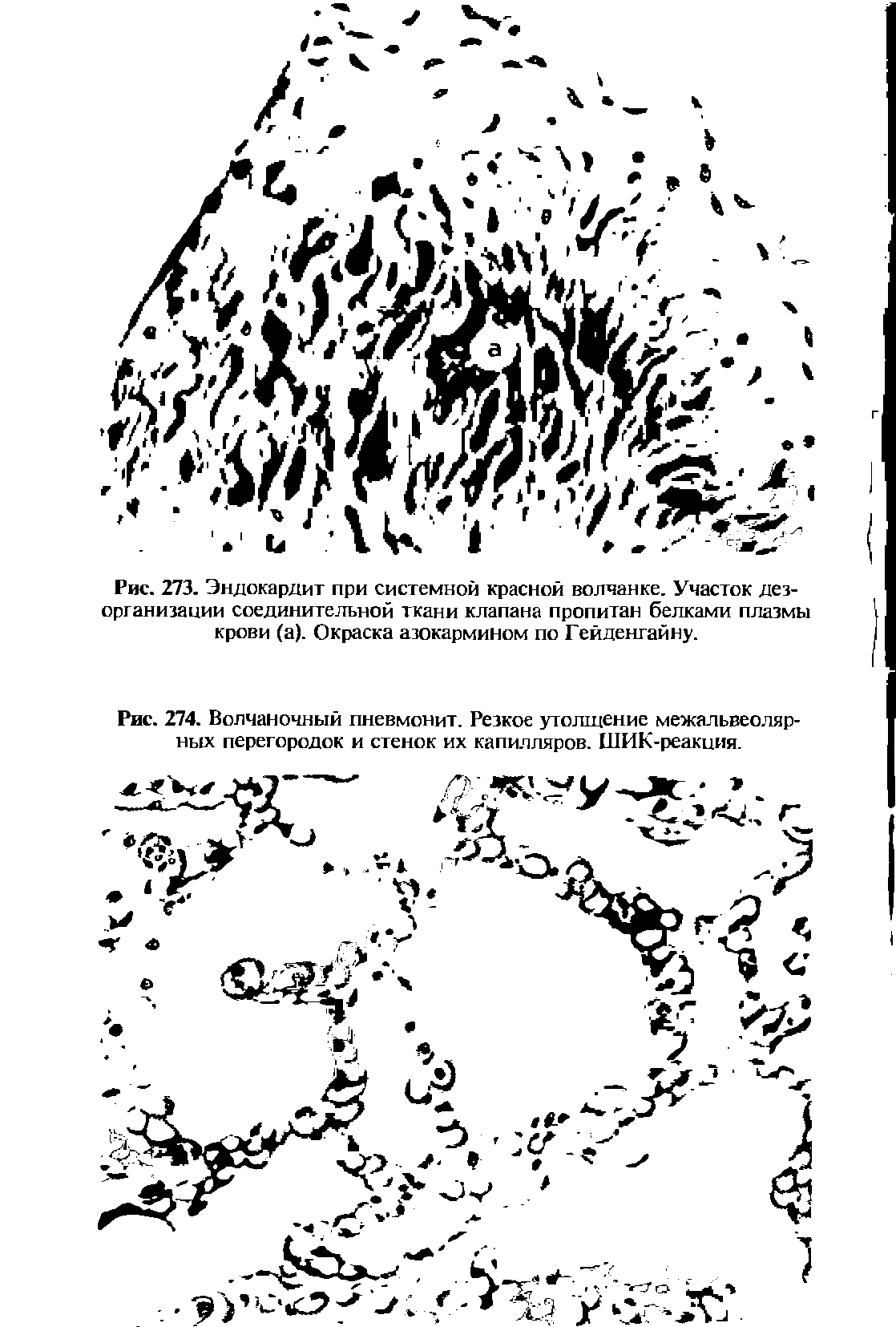 Рис. 273. Эндокардит при системной красной волчанке. Участок дезорганизации соединительной ткани клапана пропитан белками плазмы крови (а). Окраска азокармином по Гейденгайну.