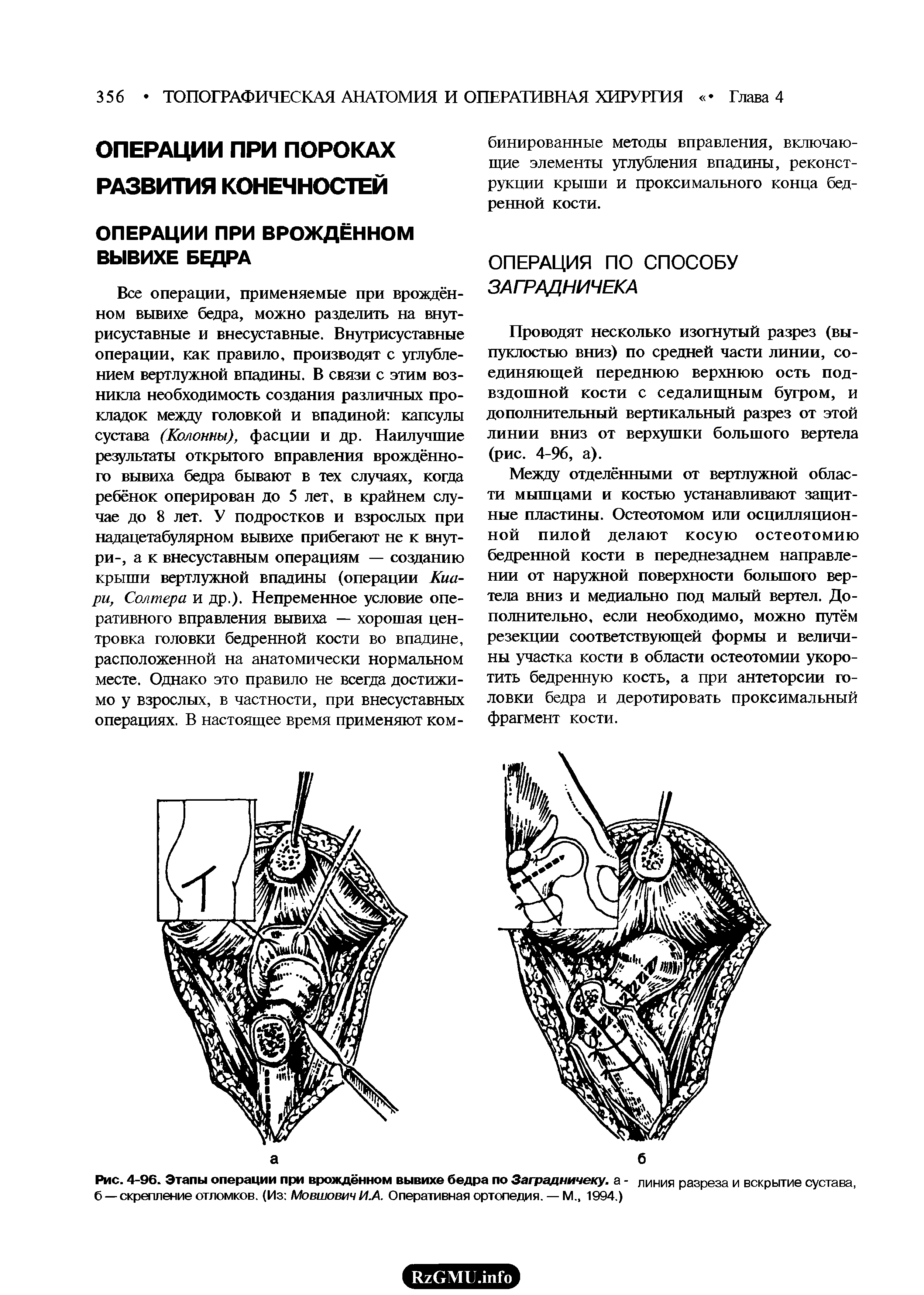 Рис. 4-96. Этапы операции при врождённом вывихе бедра по Заградничеку. а - линия разреза и вскрытие сустава, б —скрепление отломков. (Из Мовшович И.А. Оперативная ортопедия. — М 1994.)...