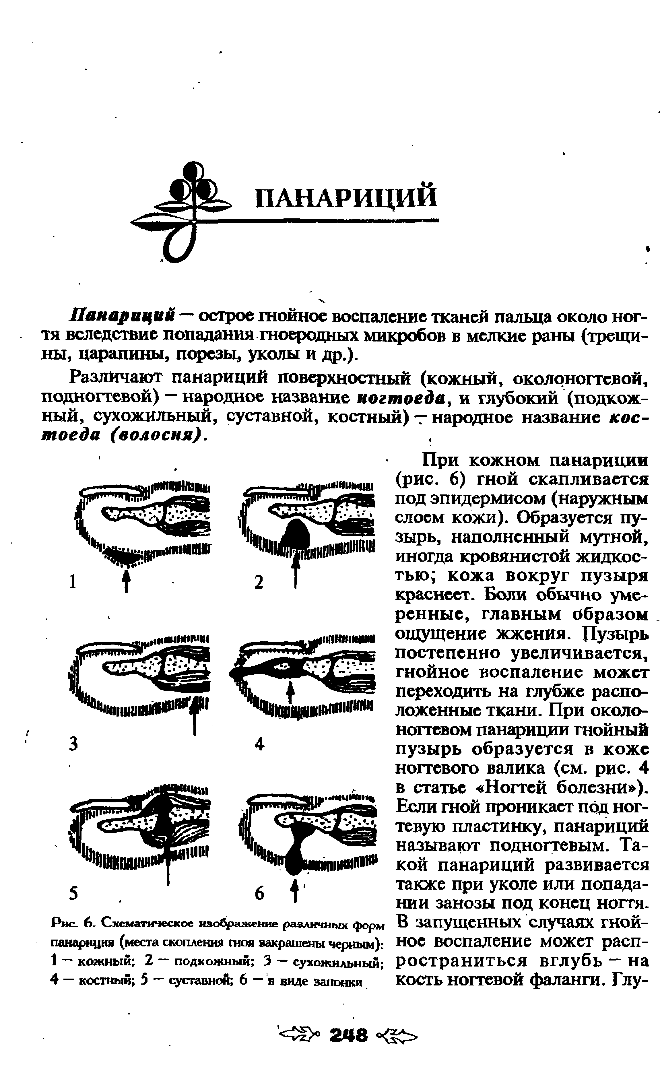 Рис. 6. Схематическое изобралкейие различных форм панариция (места скопления гноя закрашены черным) 1 — кожный 2 подкожный 3 — сухожильный 4 — костный 5 "" суставной 6 — в виде запонки...