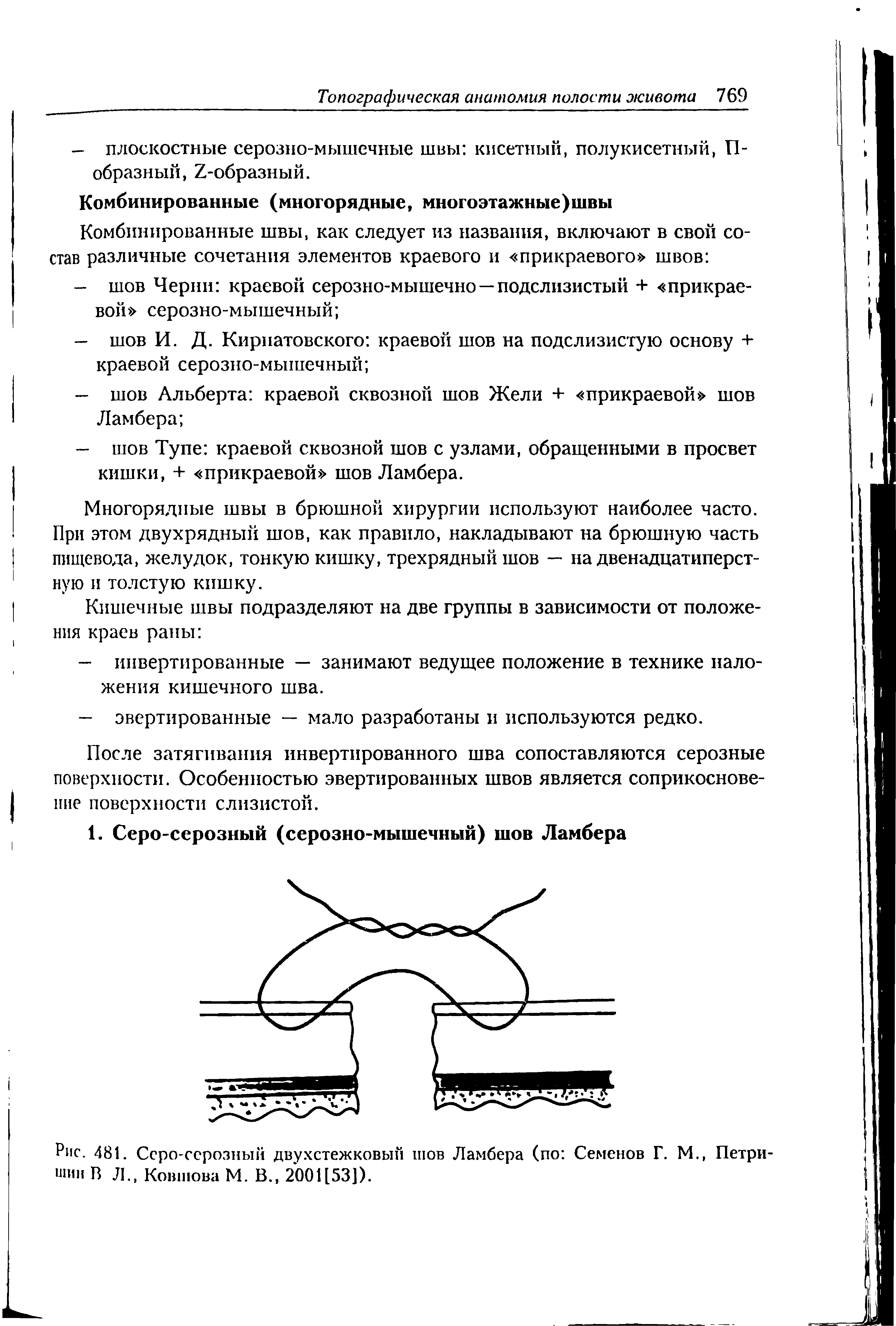 Рис. 481. Серо-серозный двухстежковый шов Ламбера (по Семенов Г. М., Петри-шин В Л., Ковшова М. В., 200Ц53]).