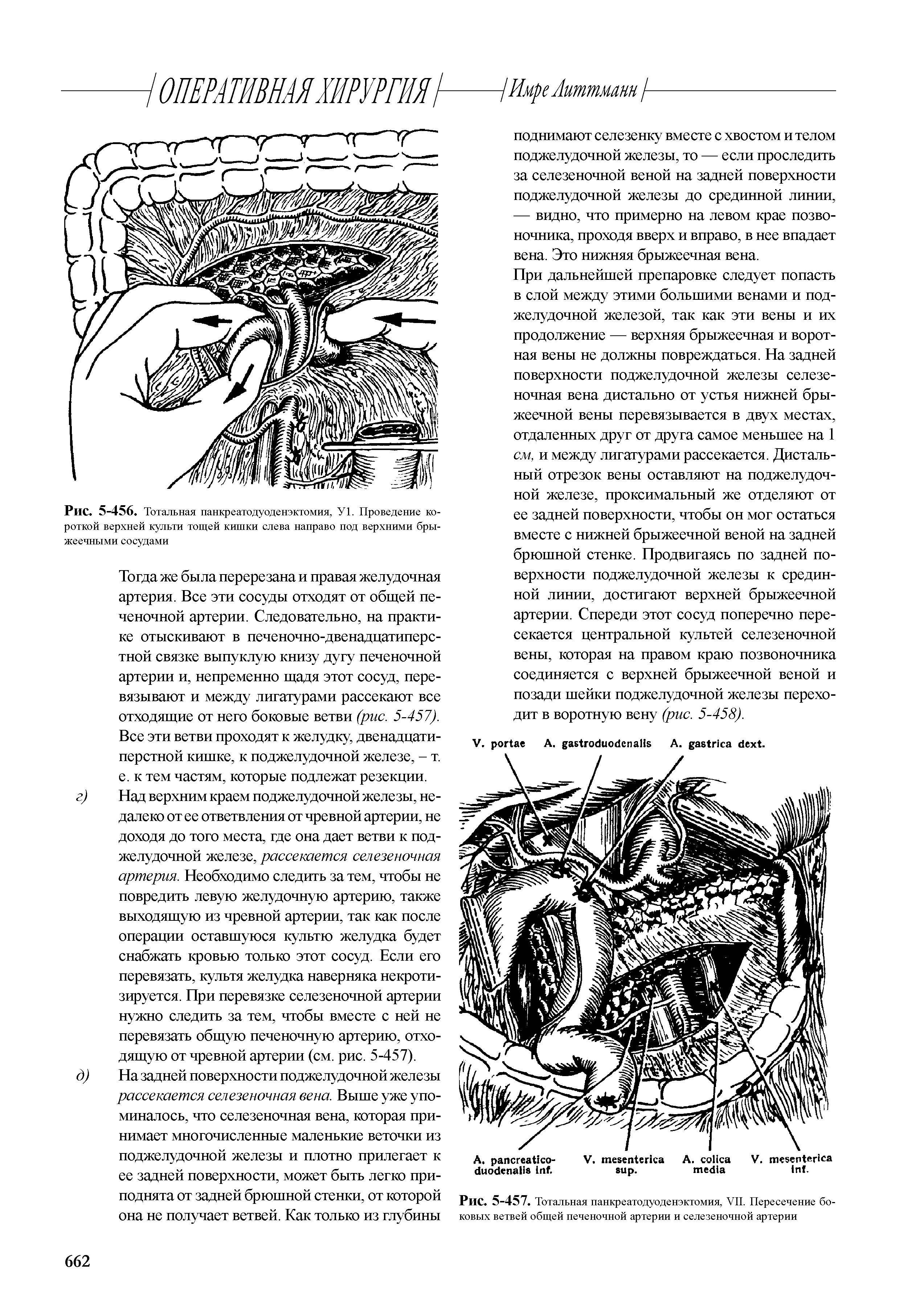 Рис. 5-456. Тотальная панкреатодуоденэктомия, У1. Проведение короткой верхней культи тощей кишки слева направо под верхними брыжеечными сосудами...