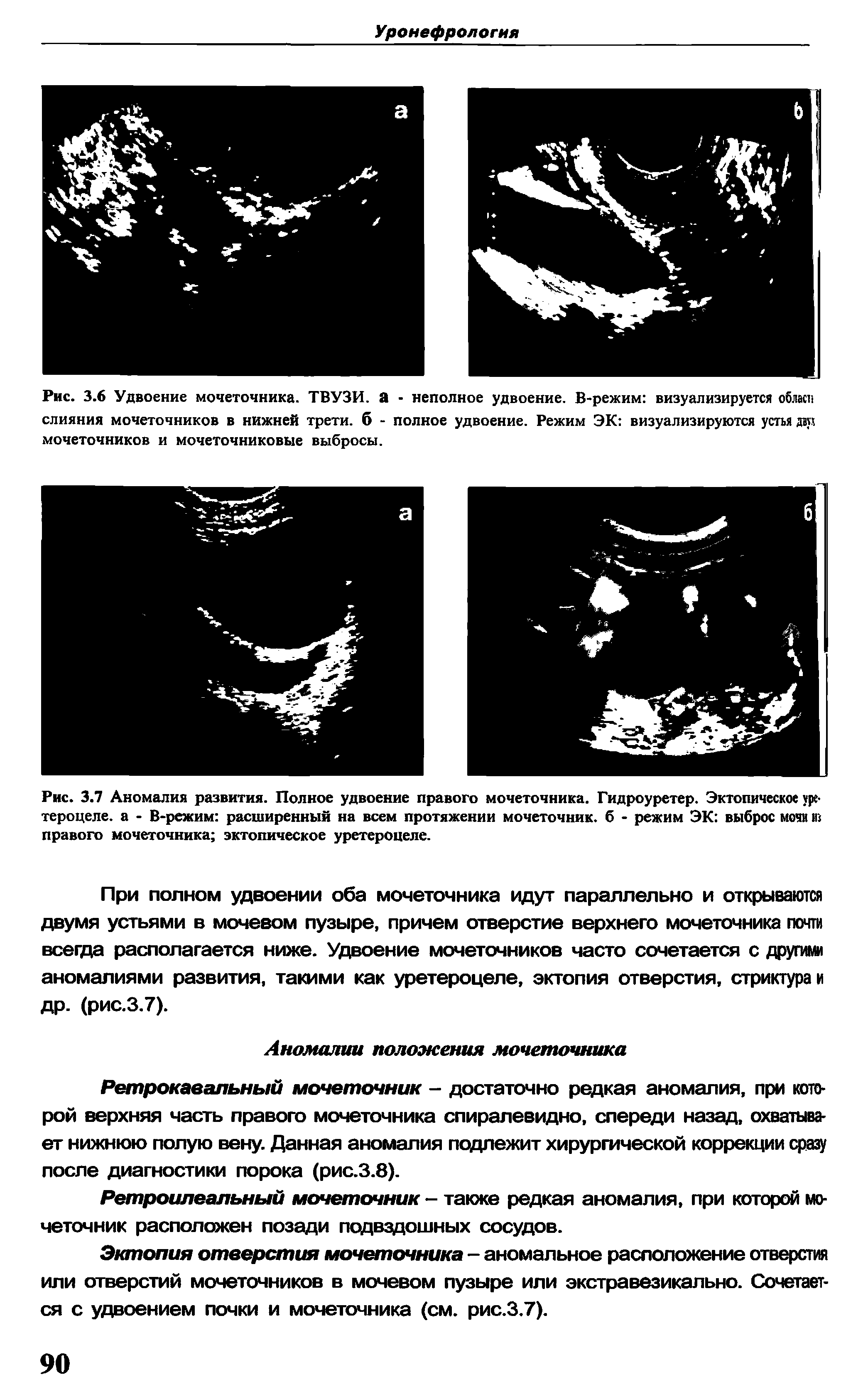Рис. 3.7 Аномалия развития. Полное удвоение правого мочеточника. Гидроуретер. Эктопическое уре-тероцеле. а - В-режим расширенный на всем протяжении мочеточник, б - режим ЭК выброс мочи из правого мочеточника эктопическое уретероцеле.