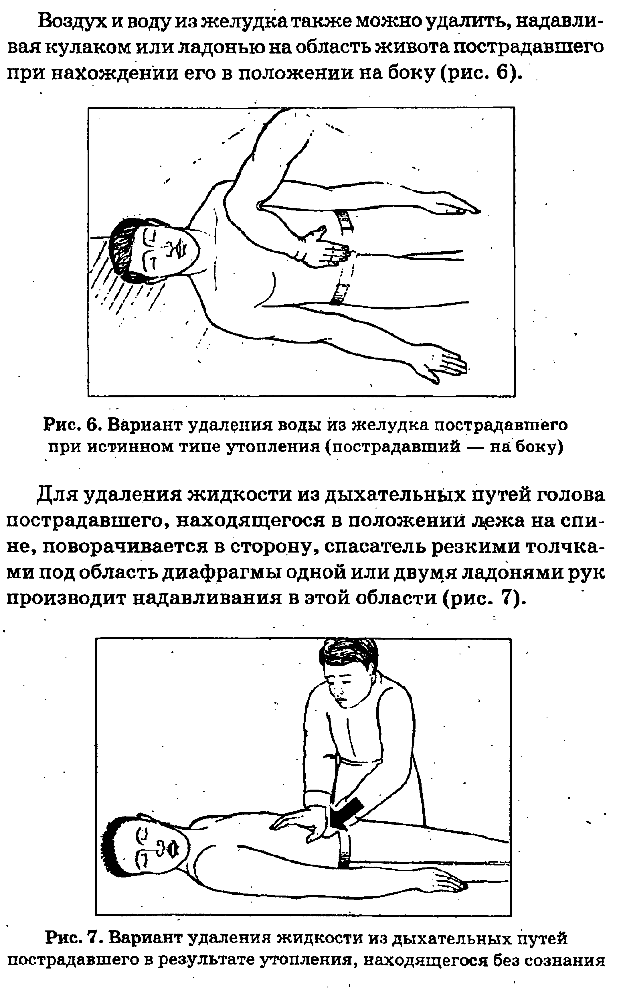 Рис. 6. Вариант удаления воды из желудка пострадавшего при истинном типе утопления (пострадавший — на боку)...