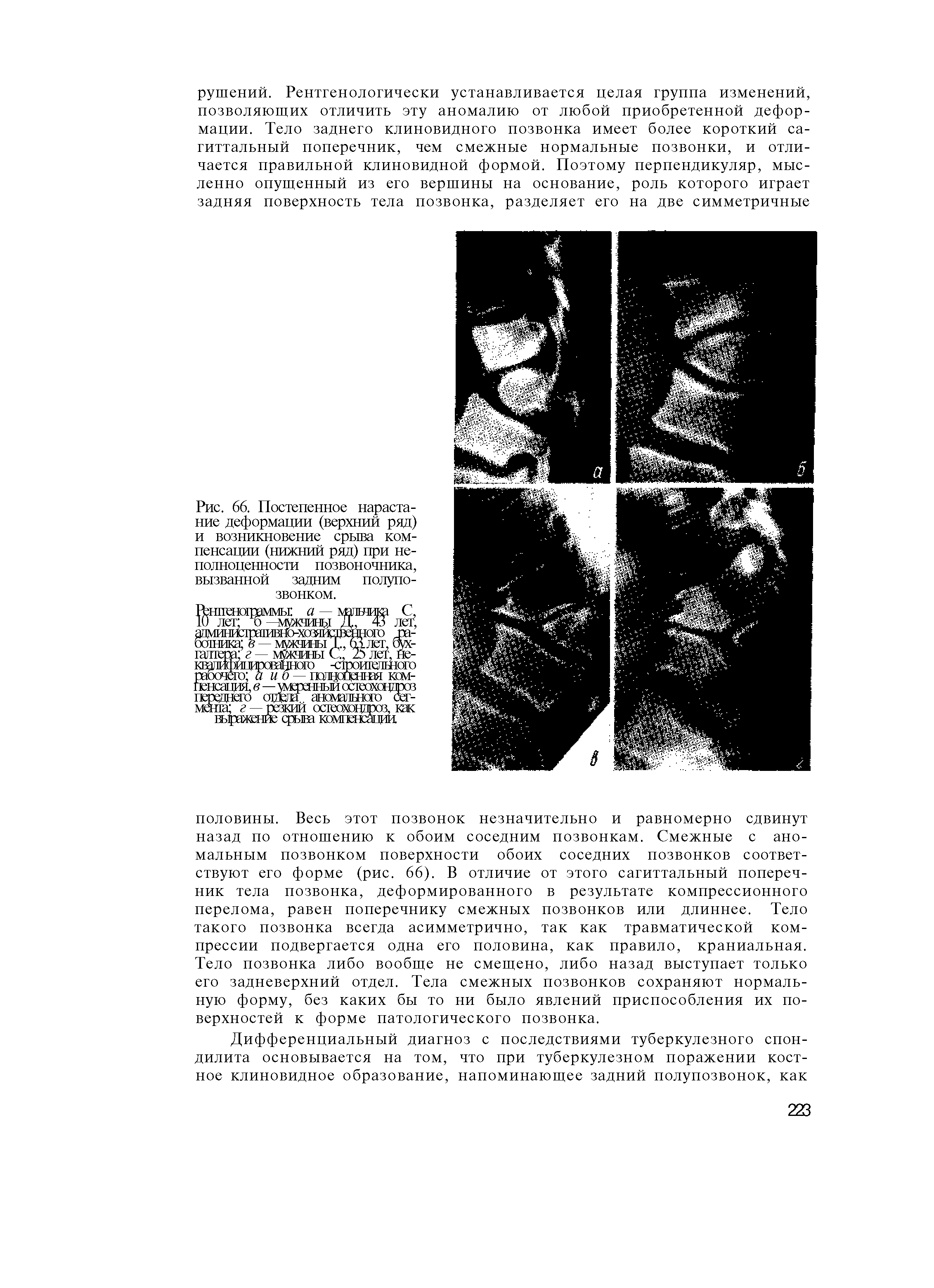 Рис. 66. Постепенное нарастание деформации (верхний ряд) и возникновение срыва компенсации (нижний ряд) при неполноценности позвоночника, вызванной задним полупозвонком.