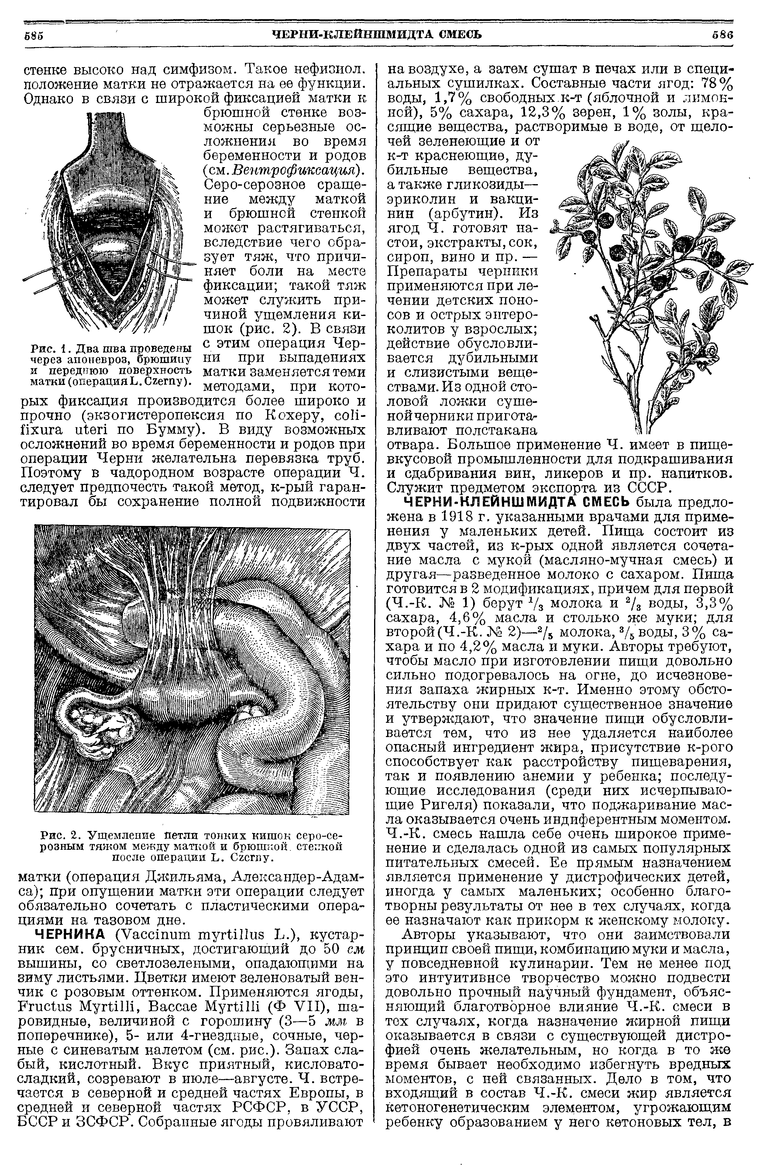 Рис. 2. Ущемление петли тонких кишок серо-серозным тяжом между маткой и брюшной, стенкой после операции L. C .