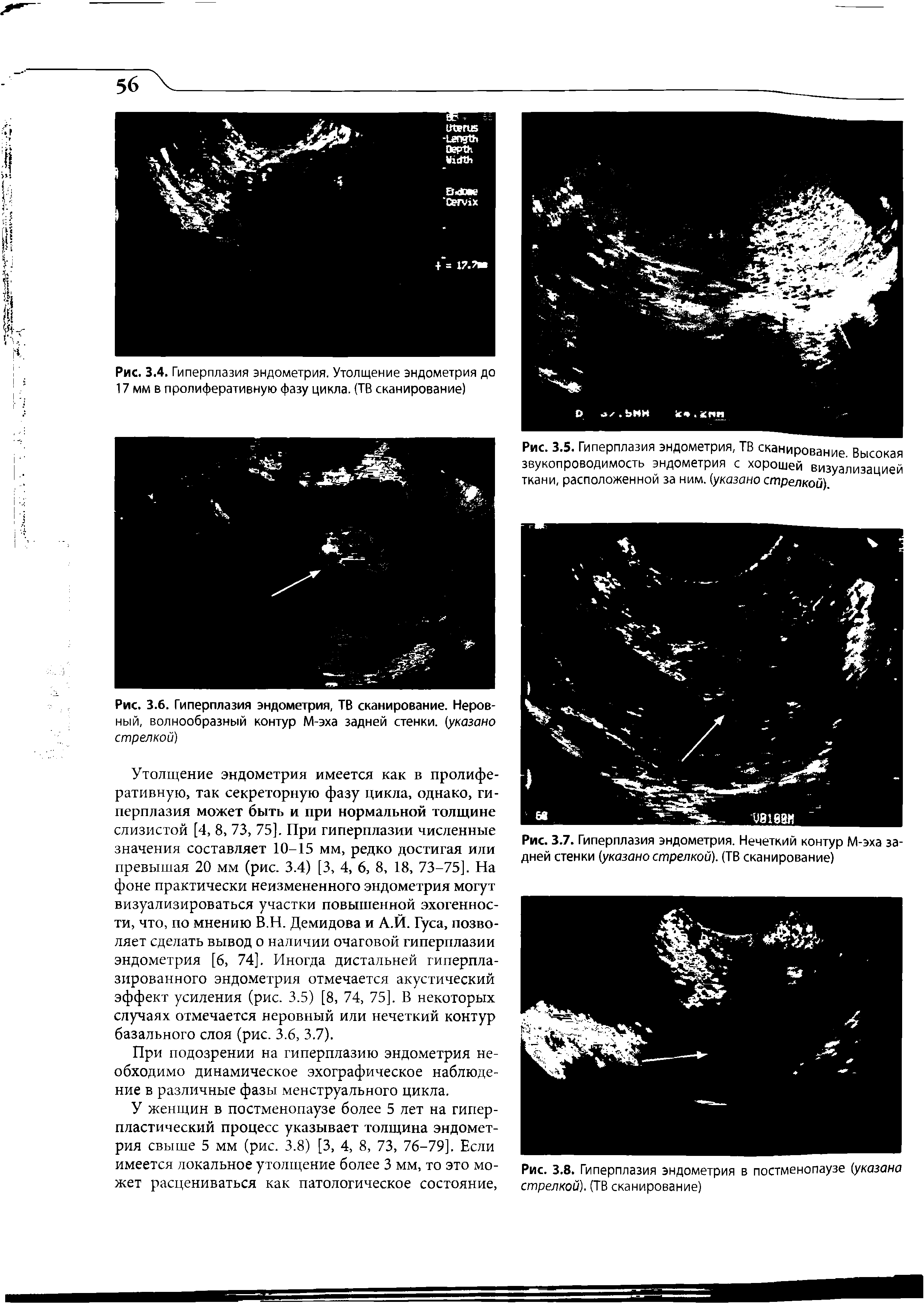 Рис. 3.6. Гиперплазия эндометрия, ТВ сканирование. Неровный, волнообразный контур М-эха задней стенки, (указано стрелкой)...