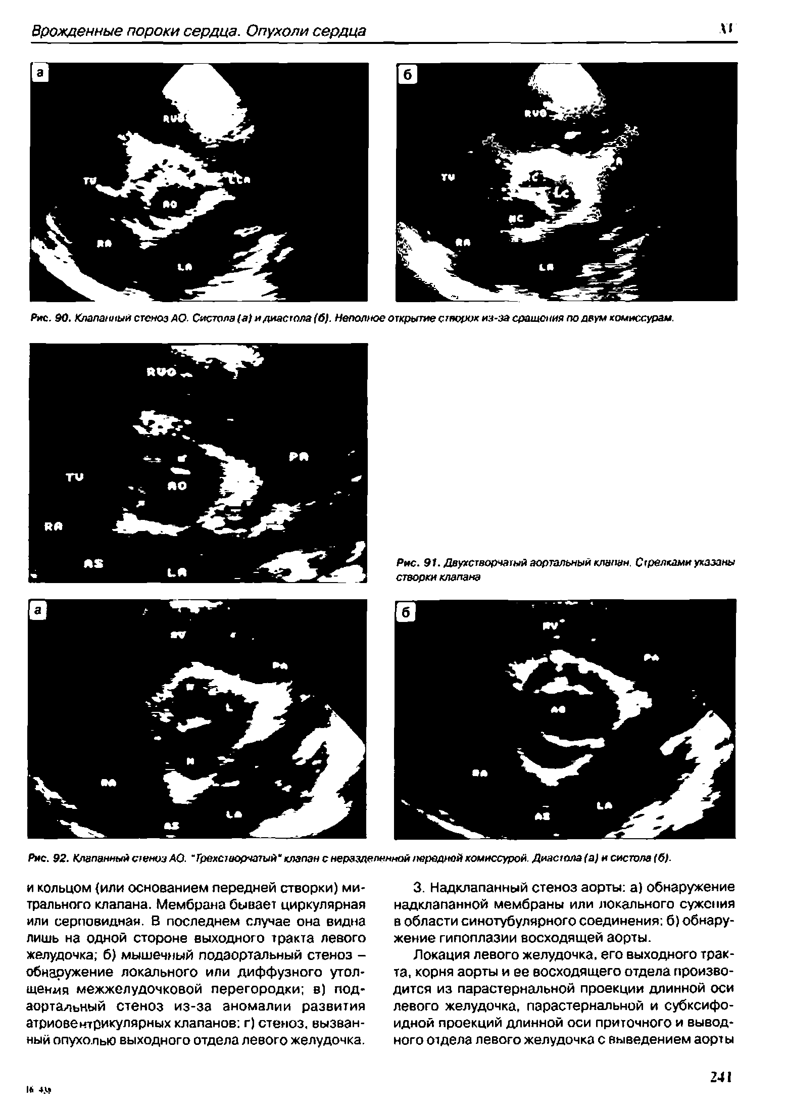 Рис. 91. Двухстворчатый аортальный клапан. Стрелками указаны створки клапана...