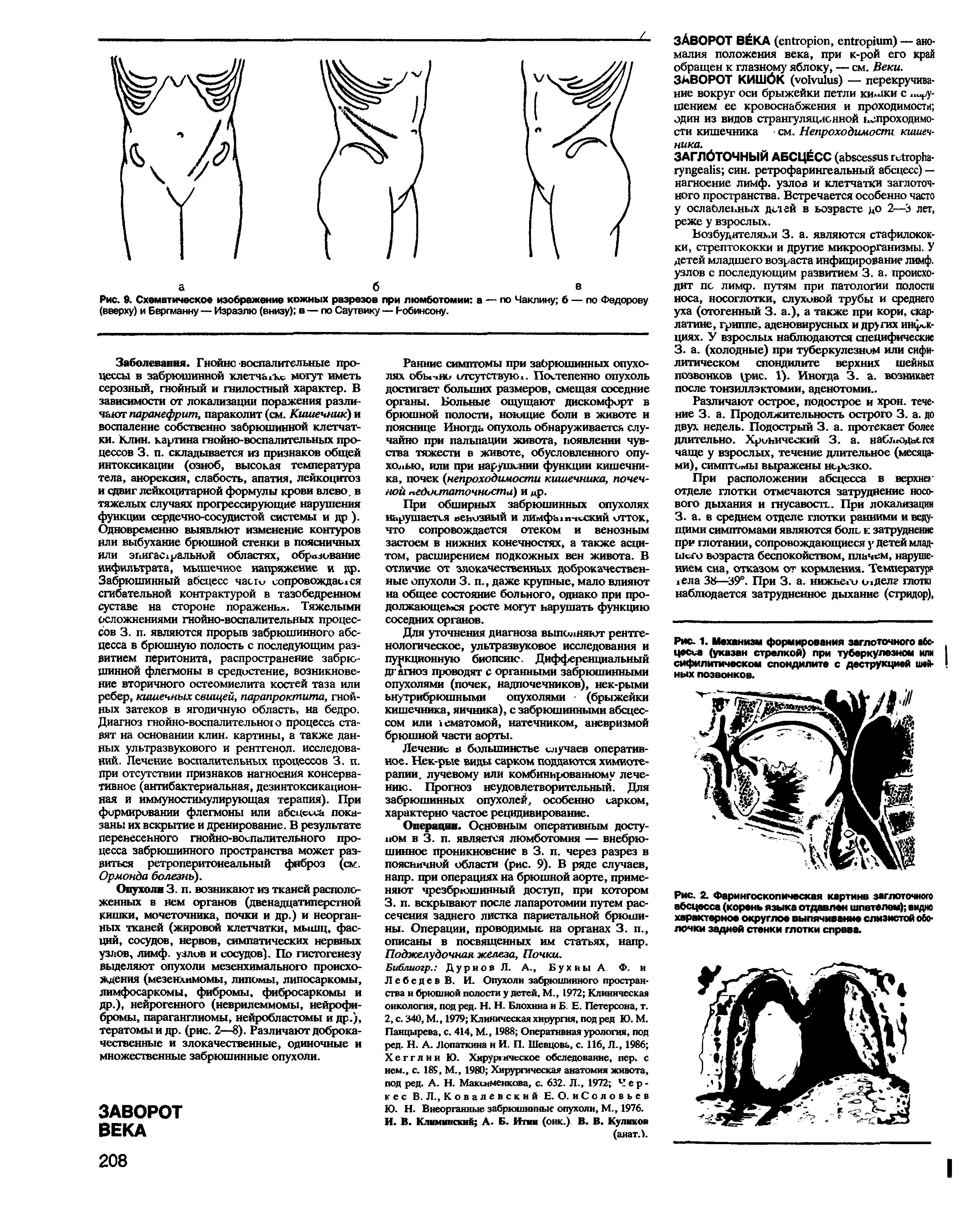 Рис. 9. Схематическое изображение кожных разрезов при люмботомии а — по Чаплину б — по Федорову (вверху) и Бергманну — Израэлю (внизу) в — по Саутвику — Робинсону.