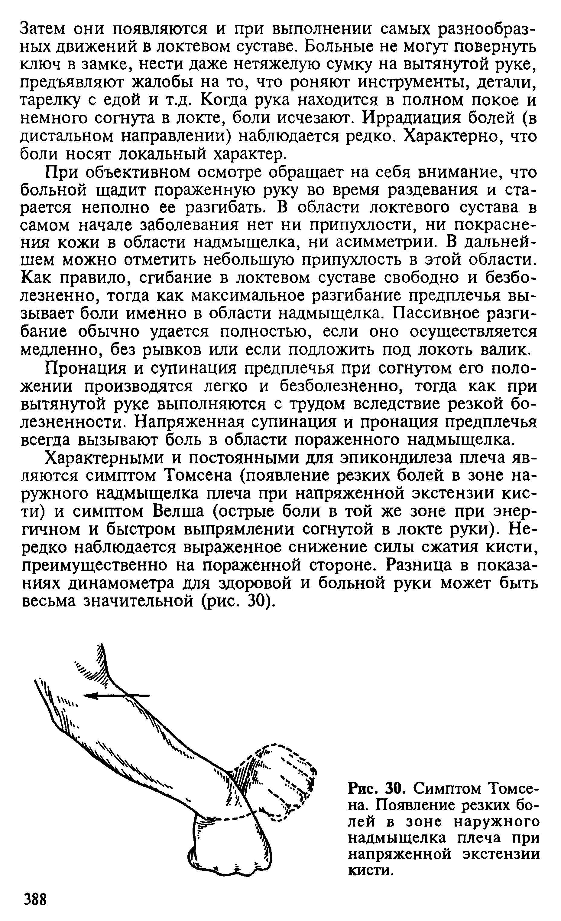 Рис. 30. Симптом Томсена. Появление резких болей в зоне наружного надмыщелка плеча при напряженной экстензии кисти.