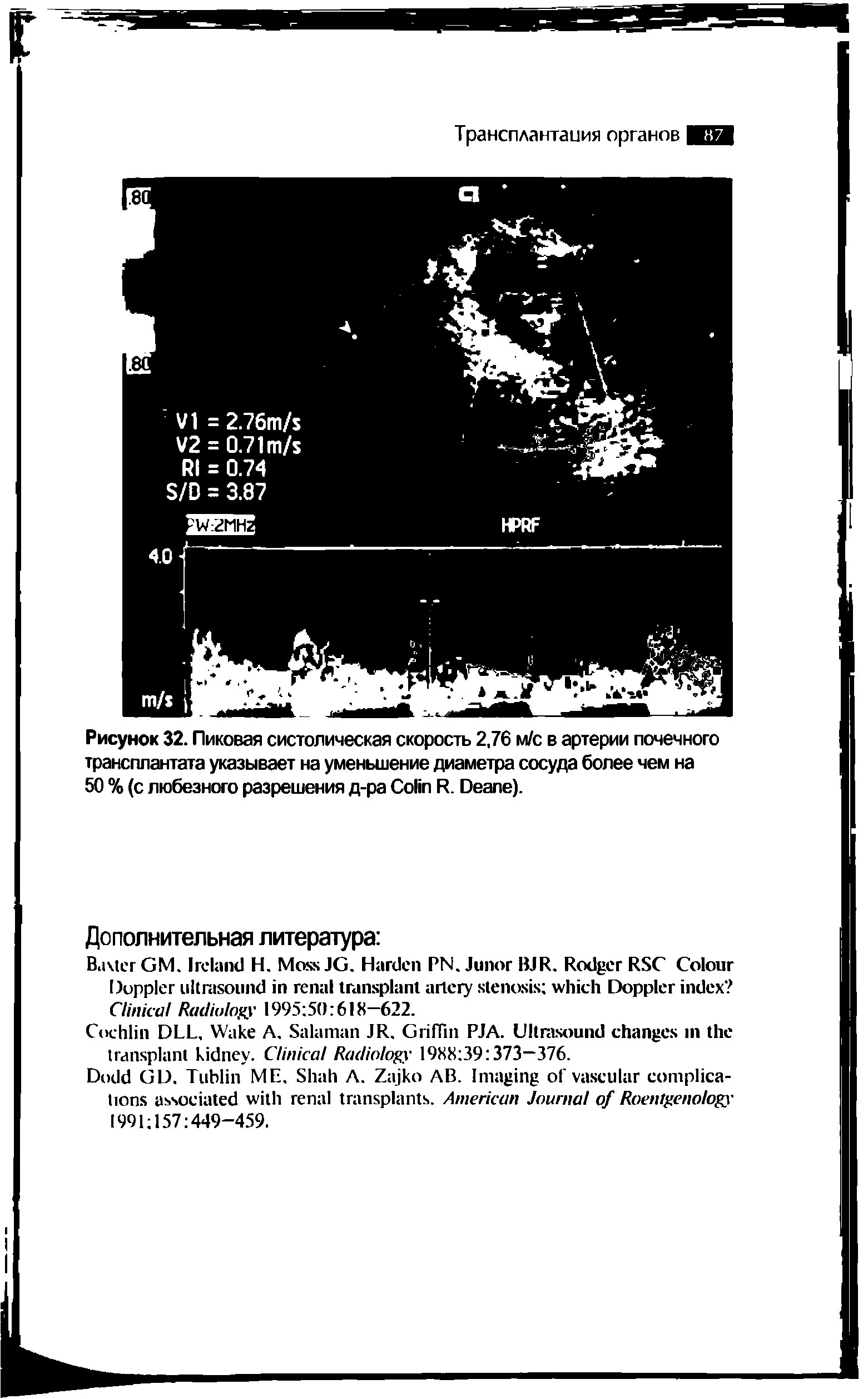 Рисунок 32. Пиковая систолическая скорость 2,76 м/с в артерии почечного трансплантата указывает на уменьшение диаметра сосуда более чем на 50 % (с любезного разрешения д-ра C R. D ).