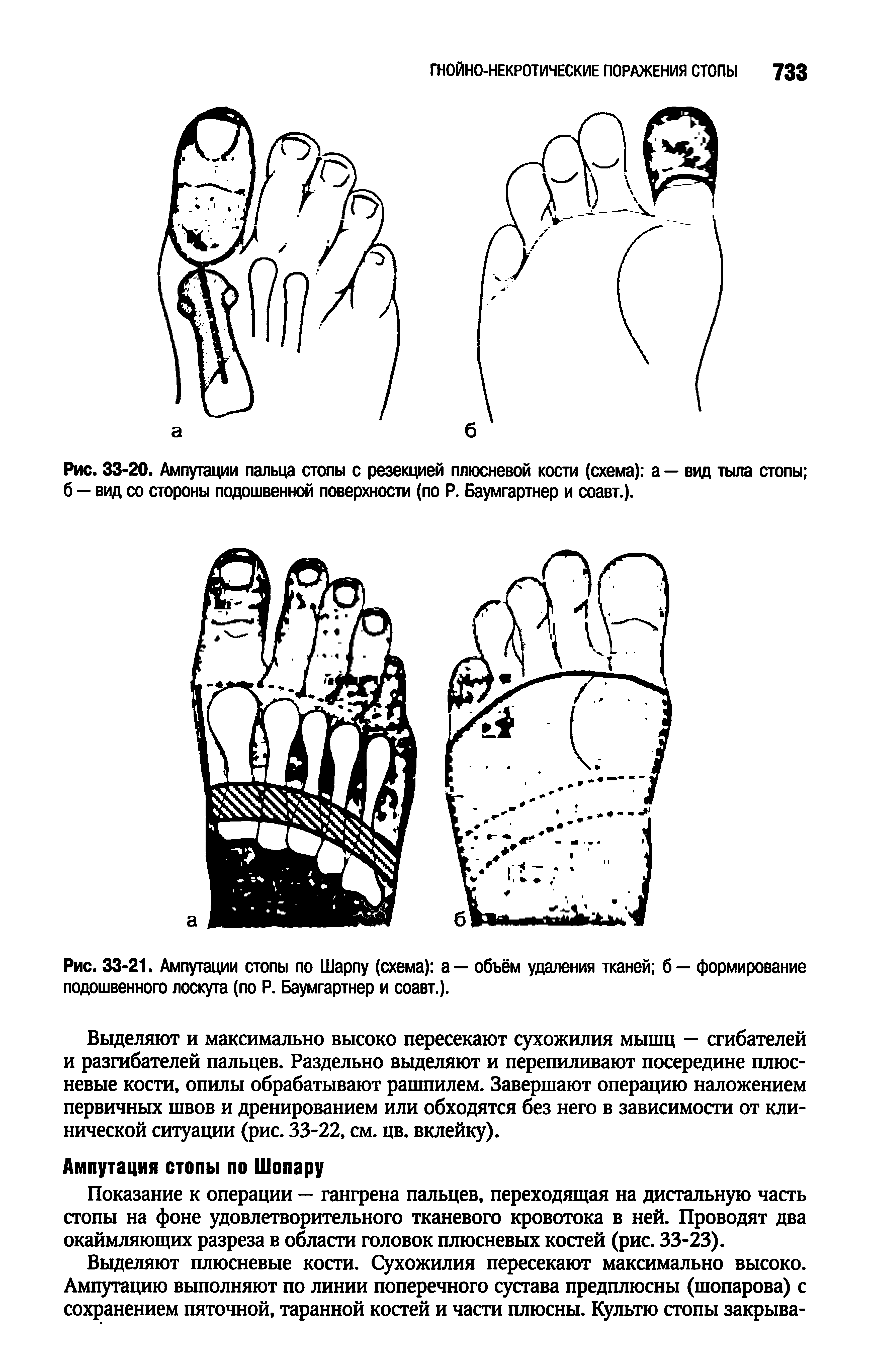 Рис. 33-21. Ампутации стопы по Шарпу (схема) а — объём удаления тканей б — формирование подошвенного лоскута (по Р. Баумгартнер и соавт.).