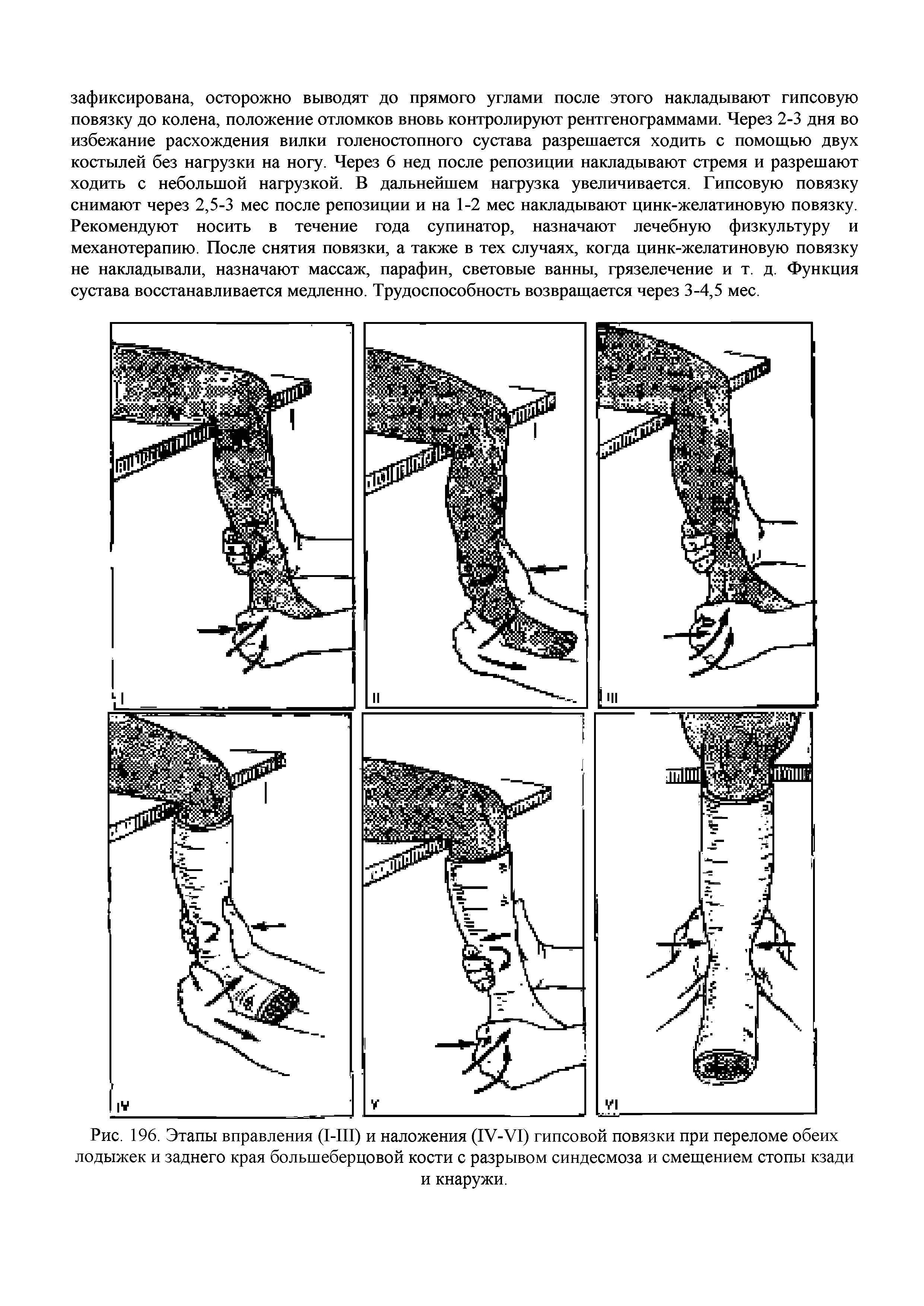 Рис. 196. Этапы вправления (1-Ш) и наложения (1У-У1) гипсовой повязки при переломе обеих лодыжек и заднего края большеберцовой кости с разрывом синдесмоза и смещением стопы кзади и кнаружи.