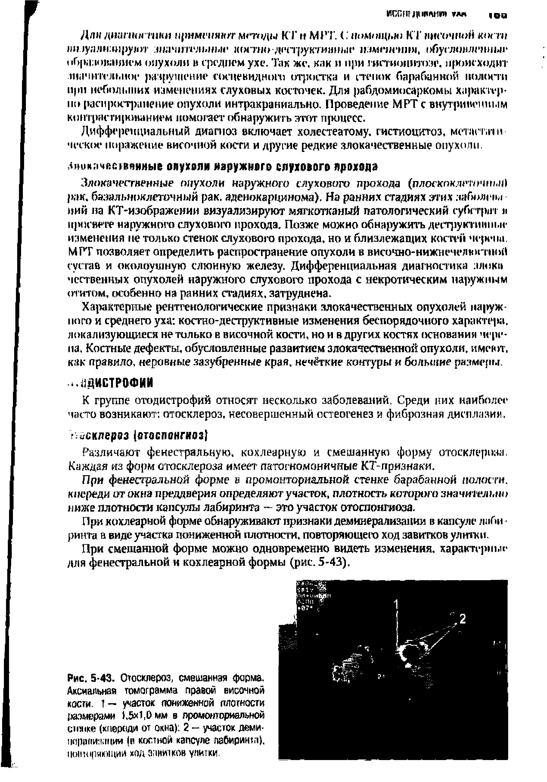 Рис. 5-43. Отосклероз, смешанная форма. Аксиальная томограмма правой височной кости. 1 - участок пониженной плотности размерами 1.5 1,0 мм в промонториальной стопке (кпереди от окна) 2 — участок деми-1 с шпи 1>тции (в костной капсуле лабиринт), 1Ю1ппрякш1ИИ ход з жи1ков улитки.