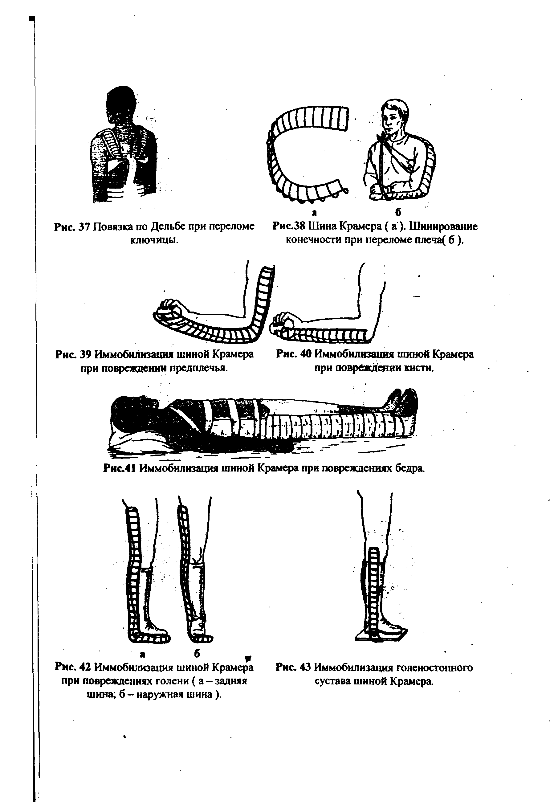 Рис. 39 Иммобилизация шиной Крамера Рис. 40 Иммобилизация шиной Крамера при повреждении предплечья. при повреждении кисти.
