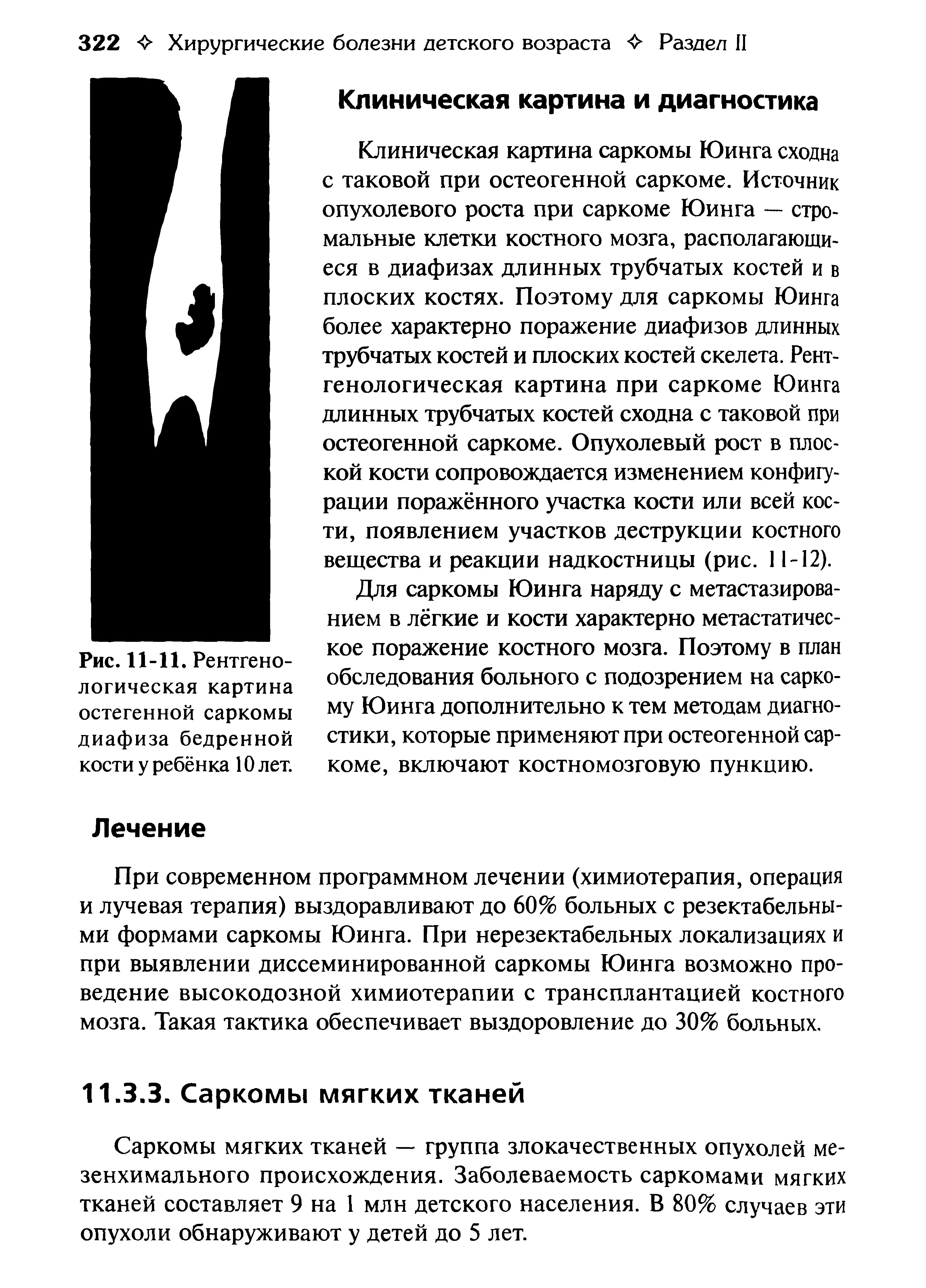 Рис. 11-11. Рентгенологическая картина остегенной саркомы диафиза бедренной кости у ребёнка 10 лет.