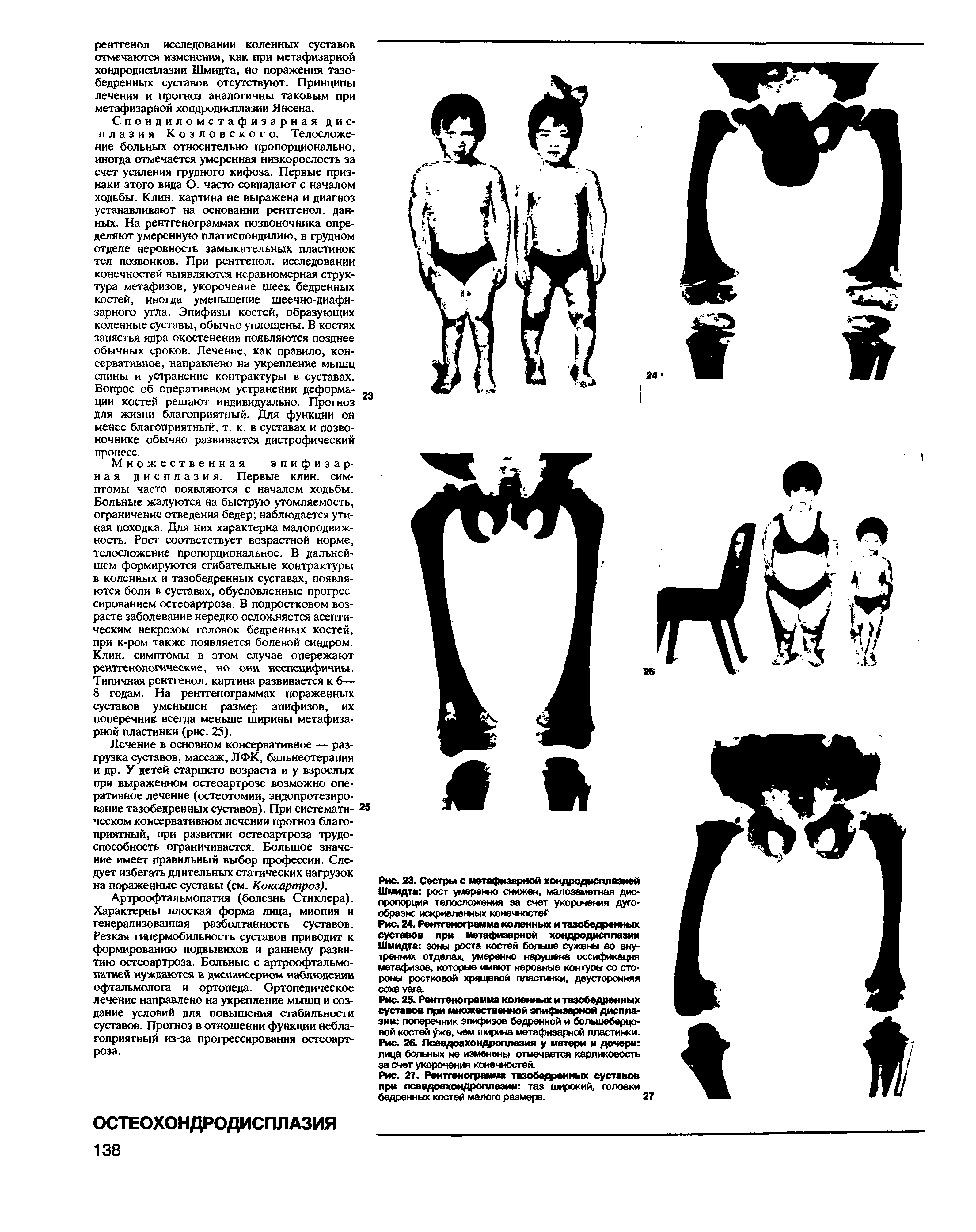 Рис. 2S. Рентгенограмма коленных и тазобедренных суставов при множественной эпифизарной дисплазии поперечник эпифизов бедренной и большеберцовой костей уже, чем ширина метафизарной пластинки. Рис. 26. Псевдоахондроплазия у матери и дочери лица больных не изменены отмечается карликовость за счет укорочения конечностей.