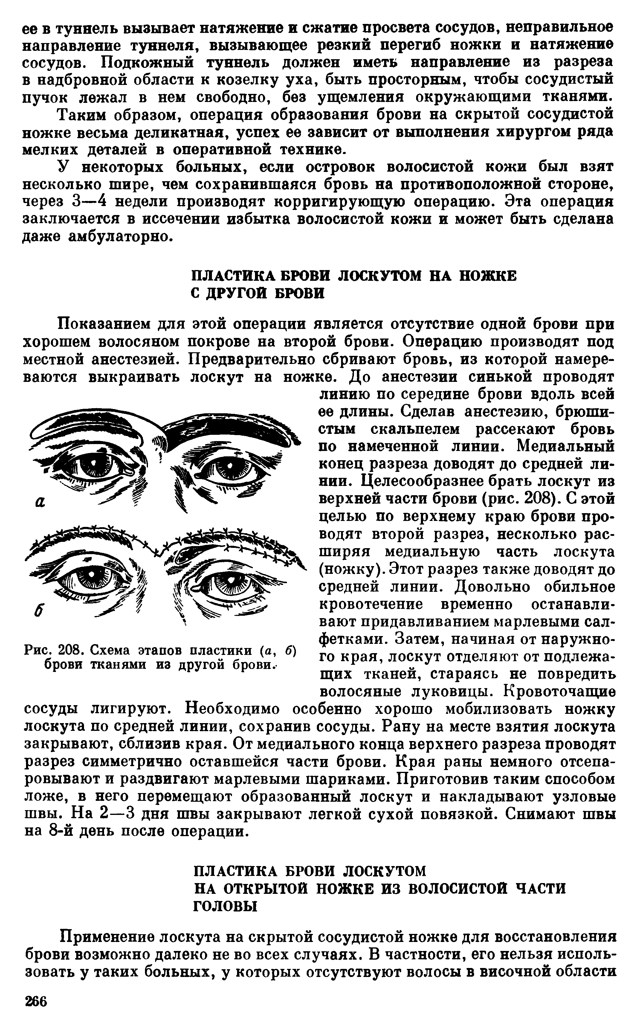 Рис. 208. Схема этапов пластики (а, б) брови тканями из другой брови.