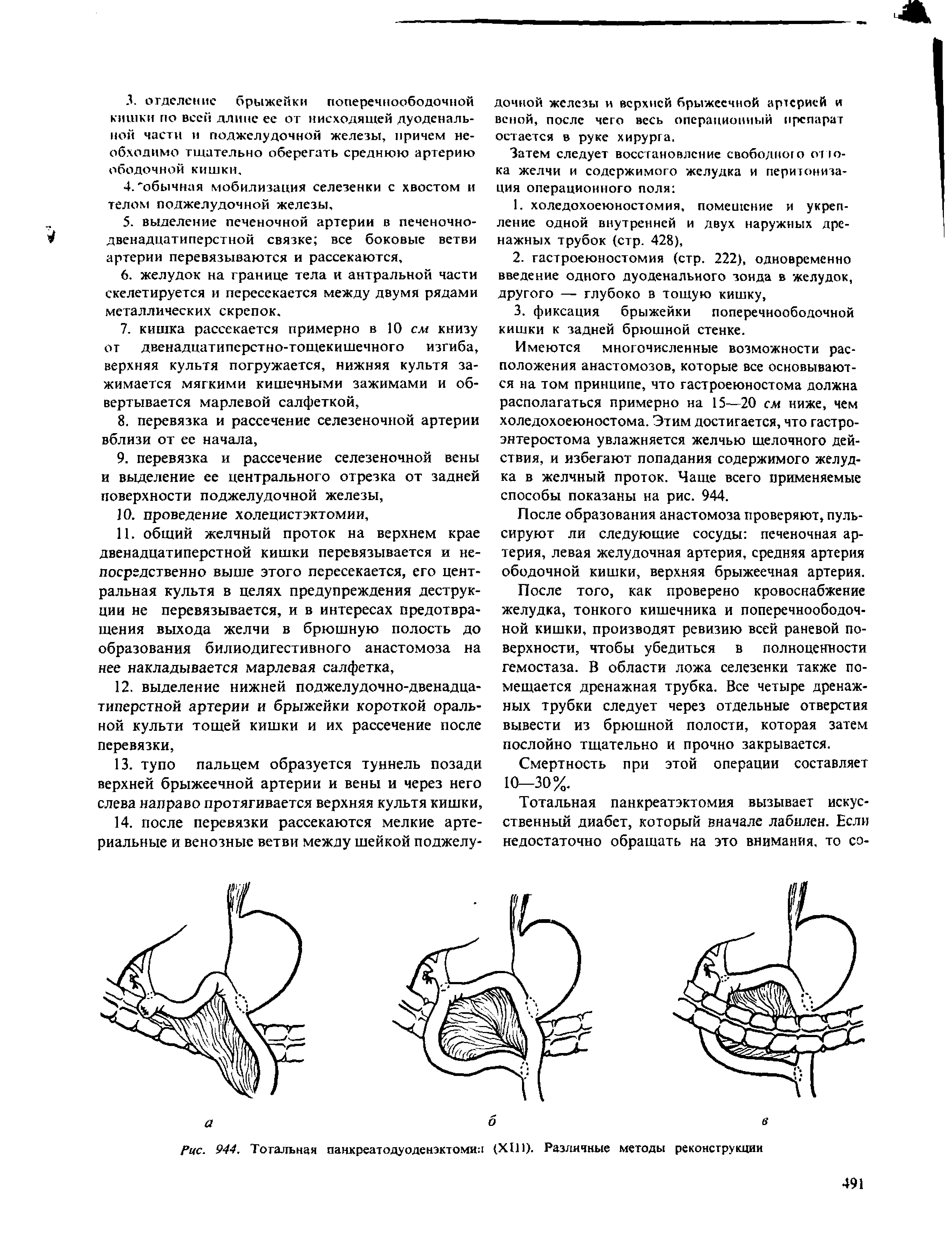 Рис. 944, Тотальная панкреатодуоденэктоми (XIII). Различные методы реконструкции...