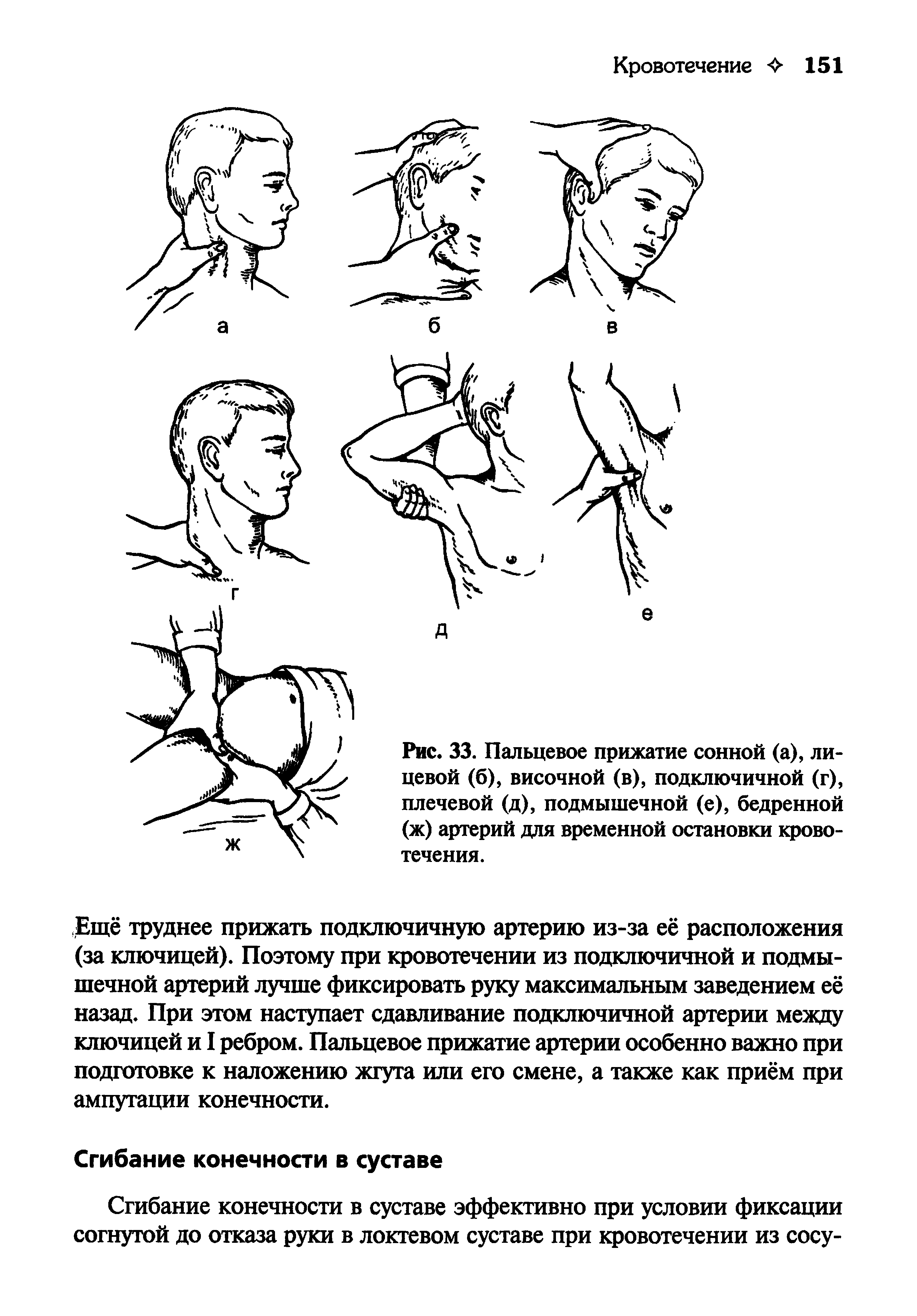 Рис. 33. Пальцевое прижатие сонной (а), лицевой (б), височной (в), подключичной (г), плечевой (д), подмышечной (е), бедренной (ж) артерий для временной остановки кровотечения.