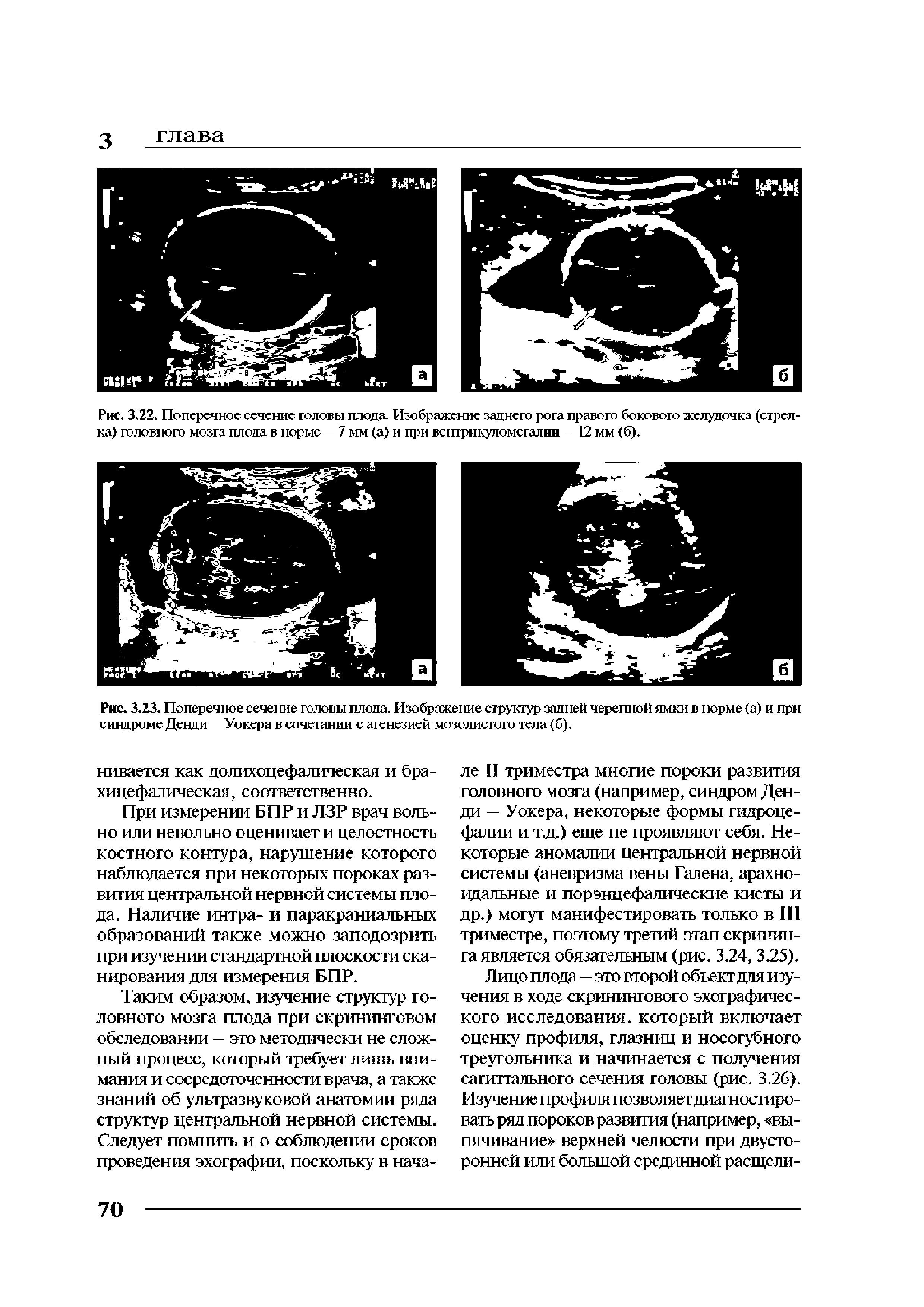 Рис. 3.22. Поперечное сечение головы плода. Изображение заднего рога правого бокового желудочка (стрелка) головного мозга плода в норме — 7 мм (а) и при вентрикуломегалии - 12 мм (б).