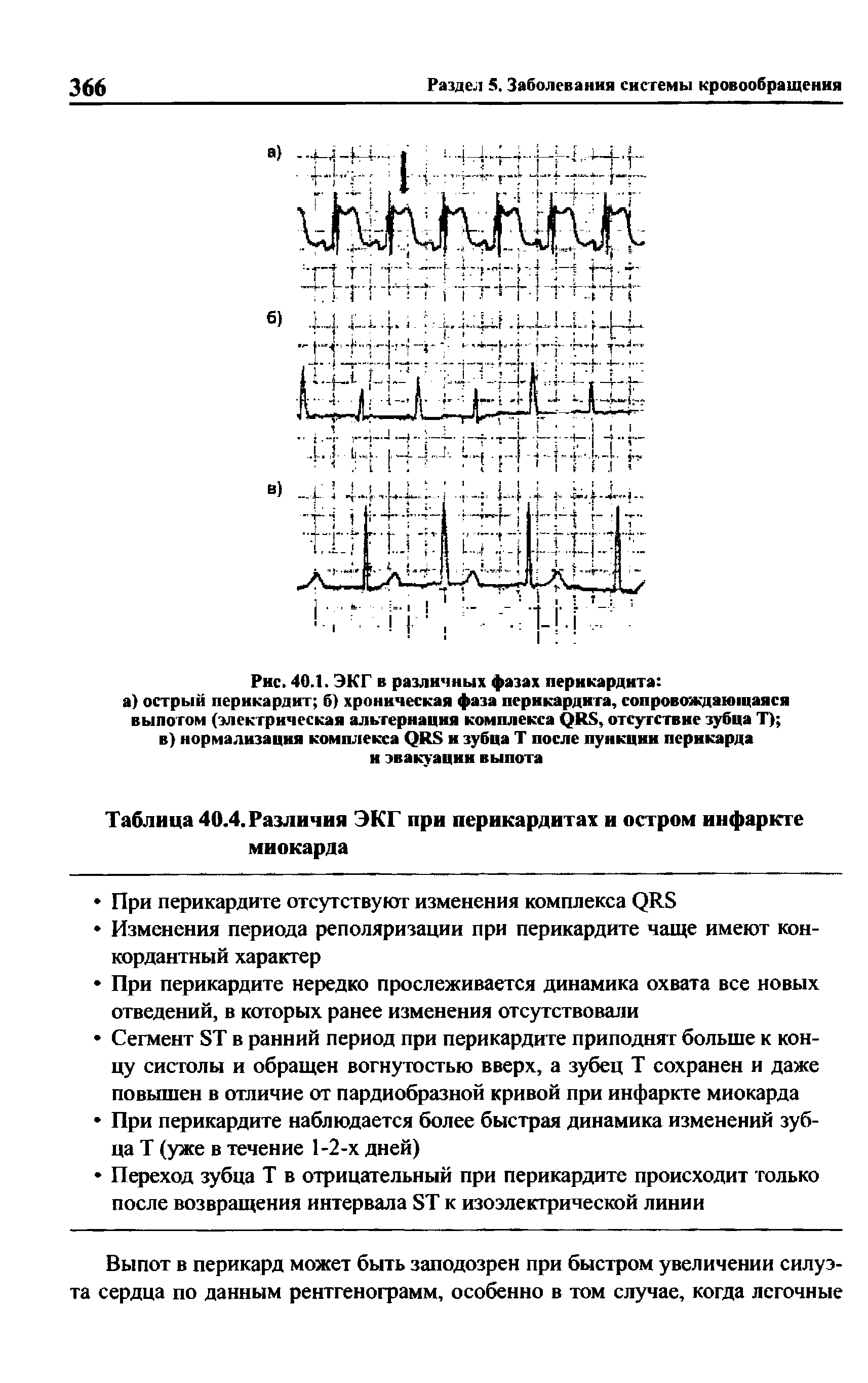 Таблица 40.4. Различия ЭКГ при перикардитах и остром инфаркте миокарда...